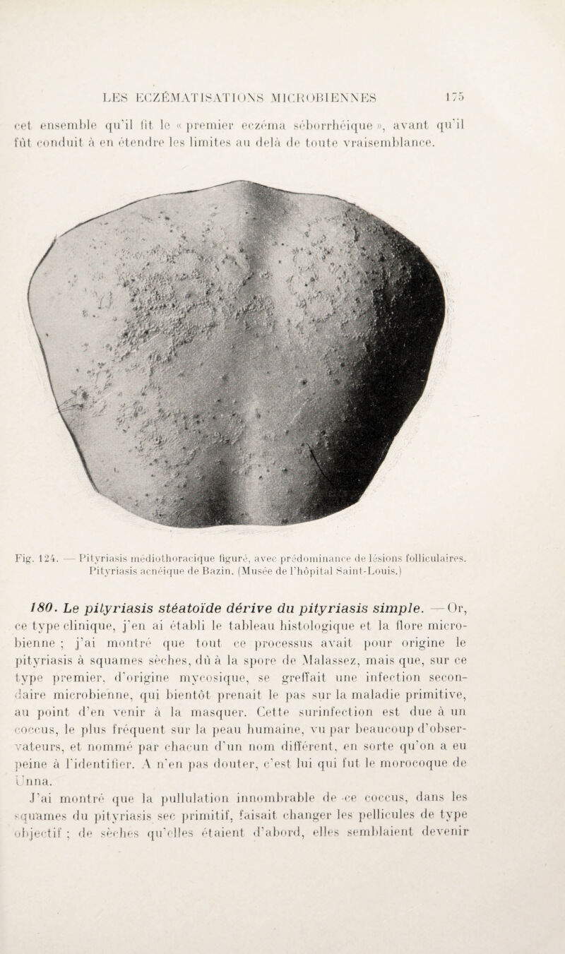 cet ensemble qu’il lit le «premier eczéma séborrhéique», avant qu'il tïit conduit à eu étendre les limites au delà de toute vraisemblance. Fig. 124. — Pityriasis médiothoracique figuré, avec prédominance de lésions folliculaires. Pityriasis acnéique de Bazin. (Musée de l’hôpital Saint-Louis.) 180. Le pityriasis stéatoide dérive du pityriasis simple. —Or, ce type clinique, j’en ai établi le tableau histologique et la flore micro¬ bienne ; j’ai montré que tout ce processus avait pour origine le pityriasis à squames sèches, du à la spore de Malassez, mais que, sur ce type premier, d’origine mycosique, se greffait une infection secon¬ daire microbienne, qui bientôt prenait le pas sur la maladie primitive, au point d’en venir à la masquer. Cette surinfection est due à un coccus, le plus fréquent sur la peau humaine, vu par beaucoup d’obser¬ vateurs, et nommé par chacun d'un nom différent, en sorte qu’on a eu peine à l'identifier. A n’en pas douter, c’est lui qui fut le morocoque de i Tina. J’ai montré que la pullulation innombrable de ce coccus, dans les squames du pityriasis sec primitif, faisait changer les pellicules de type objectif ; de sèches qu’elles étaient d’abord, elles semblaient devenir