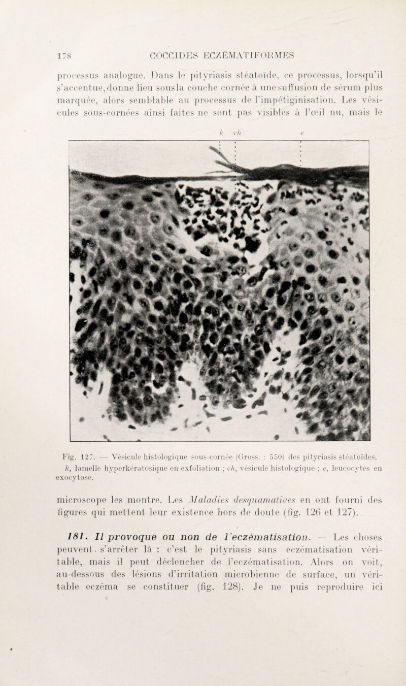 processus analogue. Dans le pityriasis stéatoïde, ce processus, lorsqu’il s’accentue, donne lieu sous la couche cornée à une suffusion de sérum plus marquée, alors semblable au processus de l’impétiginisation. Les vési¬ cules sous-cornées ainsi faites ne sont pas visibles à l’œil nu, mais le Fig. 127. — Vésicule histologique sous-cornée (Gross. : 550) des pityriasis stéatoïdes. k, lamelle hyperkératosique en exfoliation ; vh, vésicide histologique ; e, leucocytes en exocytose. microscope les montre. Les Maladies desquamatives en ont fourni des ligures qui mettent leur existence hors de doute (fig. 126 et 127). 181. Il provoque ou non de l’eczématisation. — Les choses peuvent, s’arrêter là : c’est le pityriasis sans eczématisation véri¬ table, mais il peut déclencher de l’eczématisation. Alors on voit, au-dessous des lésions d’irritation microbienne de surface, un véri¬ table eczéma se constituer (fig. 128). Je ne puis reproduire ici