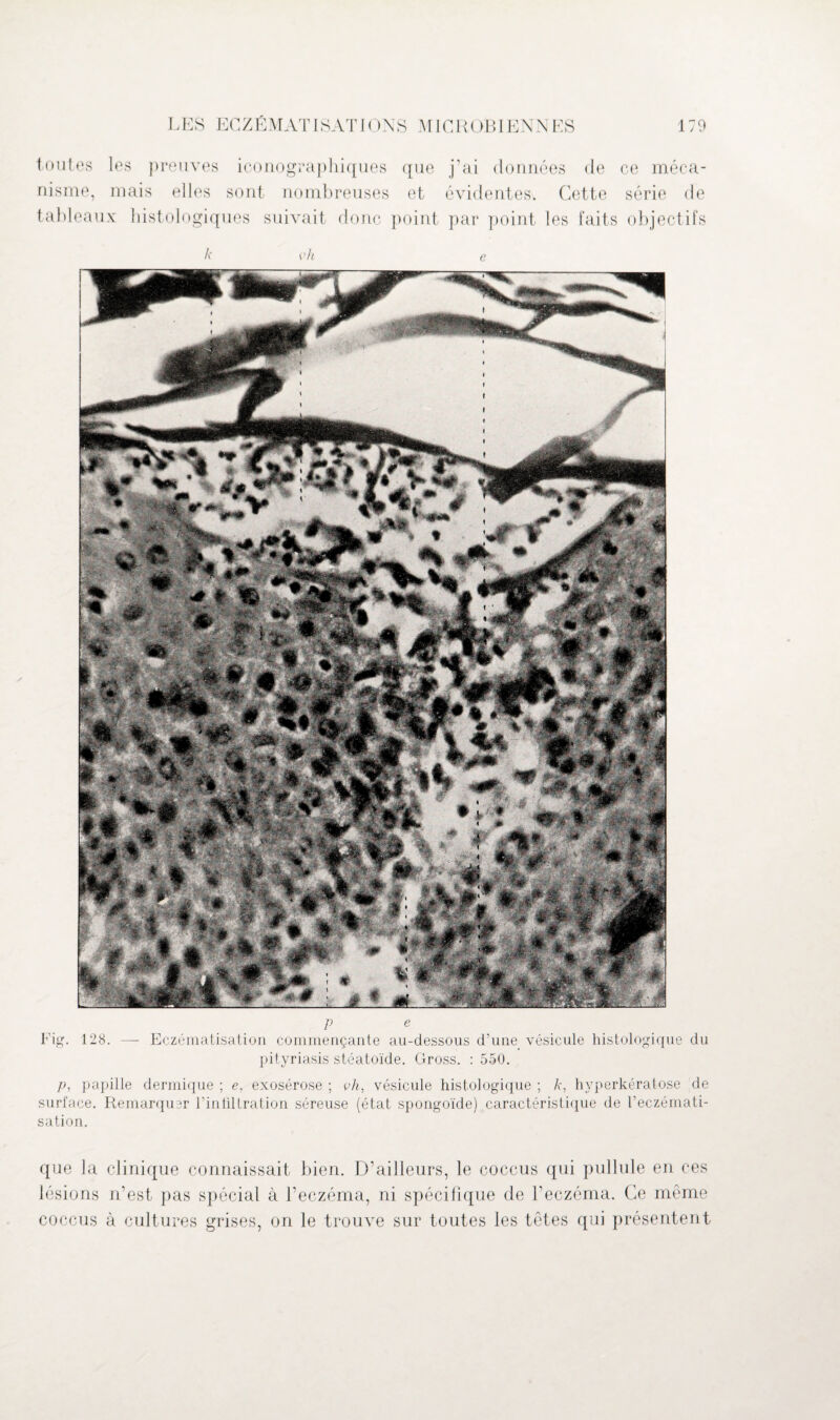 toutes les preuves iconographiques que j’ai données de ce méca¬ nisme, mais elles sont nombreuses et évidentes. Cette série de tableaux histologiques suivait donc point par point les faits objectifs h çh e P e Fig. 128. — Eczématisation commençante au-dessous d’une vésicule histologique du pityriasis stéatoïde. Gross. : 550. p, papille dermique ; e, exosérose ; vh, vésicule histologique ; k, hyperkératose de surface. Remarquer l’in tiltration séreuse (état spongoïde) caractéristique de l’eczémati¬ sation. que la lésions coccus clinique connaissait bien. D’ailleurs, le coccus qui pullule en ces n’est pas spécial à l’eczéma, ni spécifique de l’eczéma. Ce même à cultures grises, on le trouve sur toutes les têtes qui présentent