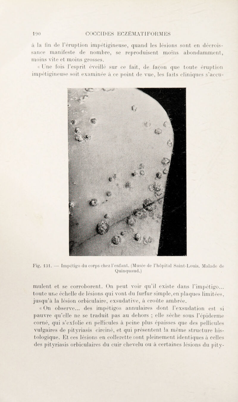 à la fin de l’éruption impétigineuse, quand les lésions sont en décrois¬ sance manifeste de nombre, se reproduisent moins abondamment, moins vite et moins grosses. « l'ne fois l’esprit éveillé sur ce fait, de façon que toute éruption impétigineuse soit examinée à ce point de vue, les faits cliniques s’accu- Fig. 131. — Impétigo du corps chez l’enfant. (Musée de l’hôpital Saint-Louis. Malade de Quinquaud.) mulent et se corroborent. On peut voir qu’il existe dans l’impétigo... toute une échelle de lésions qui vont du furfur simple, en plaques limitées, jusqu’à la lésion orbiculaire, exsudative, à croûte ambrée. « On observe... des impétigos annulaires dont l’exsudation est si pauvre qu’elle ne se traduit pas au dehors ; elle sèche sous l’épiderme corné, qui s’exfolie en pellicules à peine plus épaisses que des pellicules vulgaires de pityriasis circiné, et qui présentent la même structure his¬ tologique. Et ces lésions en collerette sont pleinement identiques à celles des pityriasis orbiculaires du cuir chevelu ou à certaines lésions du pity-