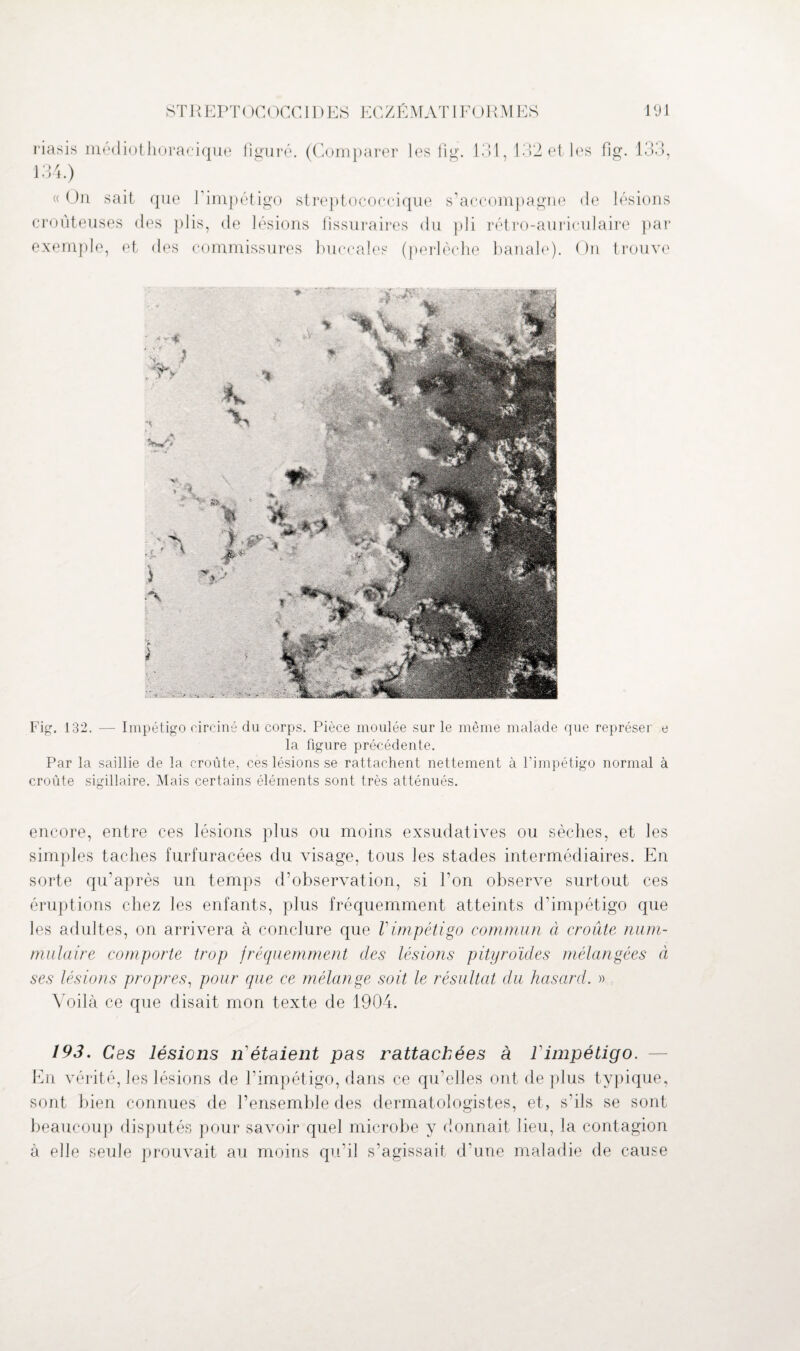 riasis médiothoracique figuré. (Comparer les llg. 131,132 et les fig. 133, 134.) « On sait que l'impétigo streptococcique s’accompagne de lésions croûteuses des plis, de lésions fissuraires du pli rétro-auriculaire par exemple, et des commissures buccales (perlèche banale). On trouve Fig. 132. — Impétigo circiné du corps. Pièce moulée sur le même malade que représer e la figure précédente. Par la saillie de la croûte, ces lésions se rattachent nettement à l'impétigo normal à croûte sigillaire. Mais certains éléments sont très atténués. encore, entre ces lésions plus ou moins exsudatives ou sèches, et les simples taches furfuracées du visage, tous les stades intermédiaires. En sorte qu’après un temps d’observation, si l’on observe surtout ces éruptions chez les enfants, plus fréquemment atteints d’impétigo que les adultes, on arrivera à conclure que Vimpétigo commun à croûte num- mulaire comporte trop fréquemment des lésions pityroules mélangées à ses lésions propres, pour que ce mélange soit le résultat du hasard. » Voilà ce que disait mon texte de 1904. 193. Ces lésions n'étaient pas rattachées à fimpétigo. En vérité, les lésions de l’impétigo, dans ce qu’elles ont de plus typique, sont bien connues de l’ensemble des dermatologistes, et, s'ils se sont beaucoup disputés pour savoir quel microbe y donnait lieu, la contagion à elle seule prouvait au moins qu’il s’agissait d'une maladie de cause