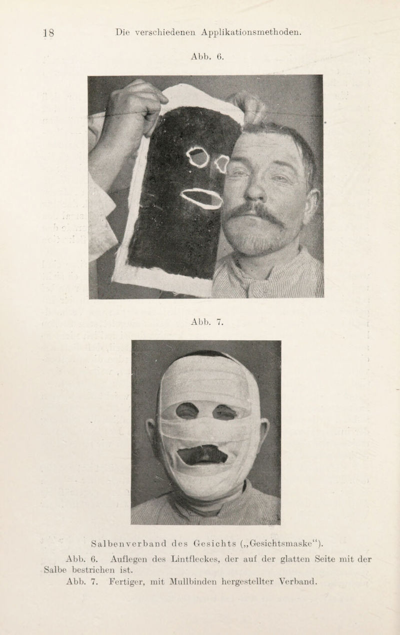 Abb, 6. Abb. 7. Salbenverband des Gesichts („Gesichtsmaske“). Abb. 6. Auflegen des Lintfleckes, der auf der glatten Seite mit der Salbe bestrichen ist. Abb. 7. Fertiger, mit Mullbinden hergestellter Verband.