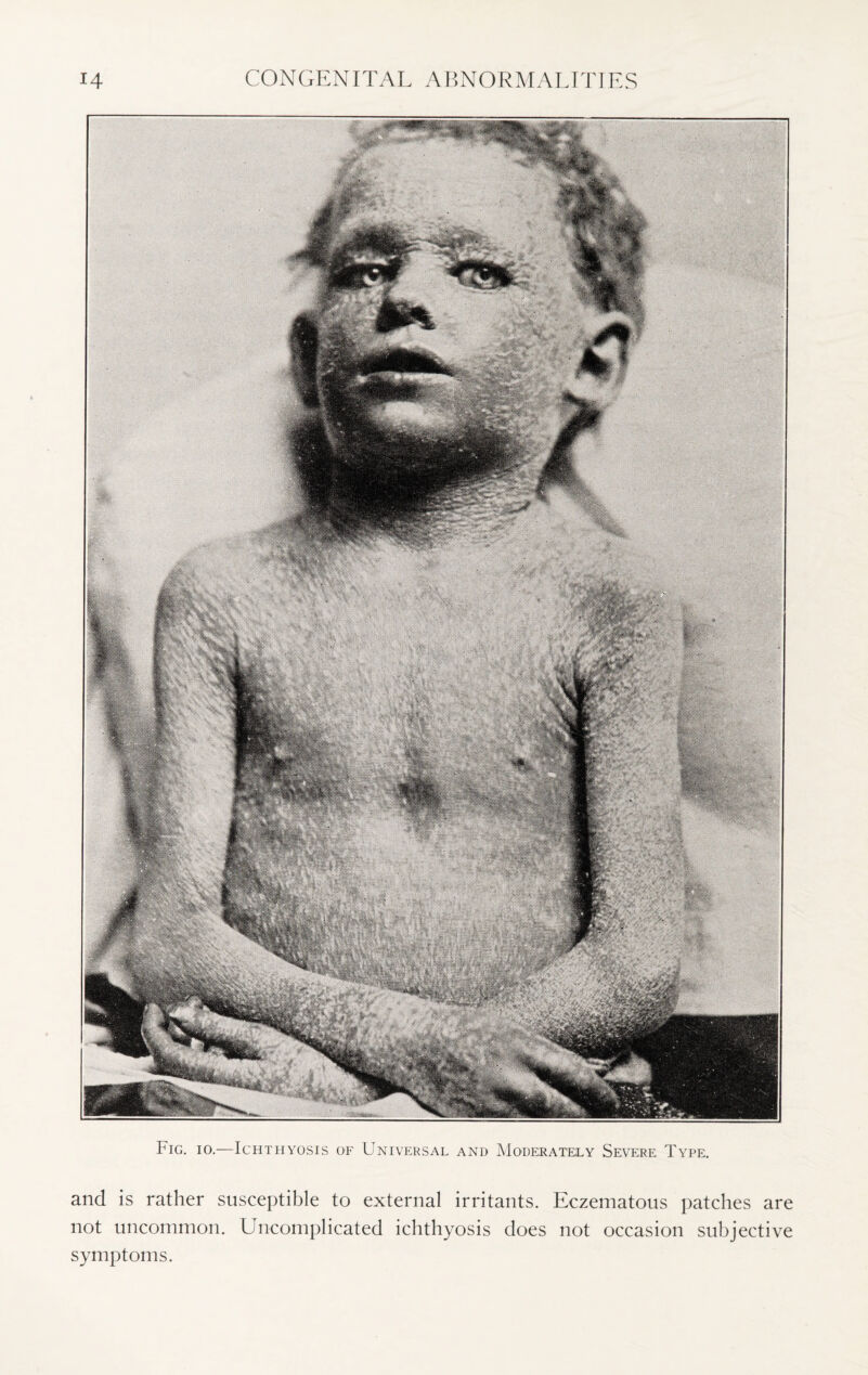 Fig. io.—Ichthyosis of Universal and Moderately Severe Type. and is rather susceptible to external irritants. Eczematous patches are not uncommon. Uncomplicated ichthyosis does not occasion subjective symptoms.