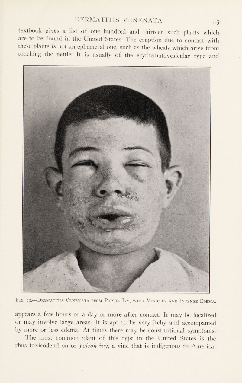 textbook gn es a. list of one hundred and thirteen such plants which aie to be found in the United States, the eruption due to contact with these plants is not an ephemeral one, such as the wheals which arise from touching the nettle. It is usually of the erythematovesicular type and Fig. 19.—Dermatitis Venenata from Poison Ivy, with Vesicles and Intense Edema. appears a few hours or a day or more after contact. It may be localized or may involve large areas. It is apt to be very itchy and accompanied by more or less edema. At times there may be constitutional symptoms. The most common plant of this type in the United States is the rhus toxicodendron or poison ivy, a vine that is indigenous to America,
