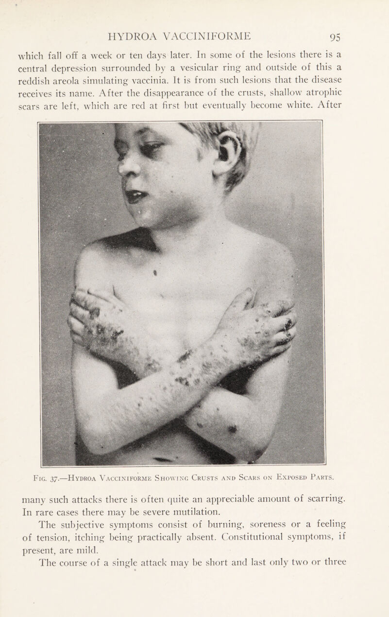 which fall off a week or ten clays later. In some of the lesions there is a central depression surrounded by a vesicular ring and outside of this a reddish areola simulating vaccinia. It is from such lesions that the disease receives its name. After the disappearance of the crusts, shallow atrophic scars are left, which are red at first but eventually become white. After Fig. 37.—Hydroa Vacciniforme Showing Crusts and Scars on Exposed Parts. many such attacks there is often quite an appreciable amount of scarring. In rare cases there may be severe mutilation. The subjective symptoms consist of burning, soreness or a feeling of tension, itching being practically absent. Constitutional symptoms, if present, are mild. The course of a single attack may be short and last only two or three