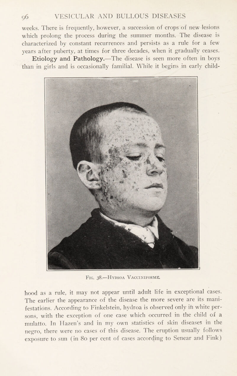 weeks. There is frequently, however, a succession of crops of new lesions which prolong the process during the summer months. The disease is characterized by constant recurrences and persists as a rule for a few years after puberty, at times for three decades, when it gradually ceases. Etiology and Pathology.—The disease is seen more often in boys than in girls and is occasionally familial. While it begins in early child- Fig. 38.—Hydroa Vacciniforme. hood as a rule, it may not appear until adult life in exceptional cases. The earlier the appearance of the disease the more severe are its mani¬ festations. According to Finkelstein, hydroa is observed only in white per¬ sons, with the exception of one case which occurred in the child of a mulatto. In Hazen’s and in my own statistics of skin diseases in the negro, there were no cases of this disease. The eruption usually follows exposure to sun (in 80 per cent of cases according to Senear and Fink)