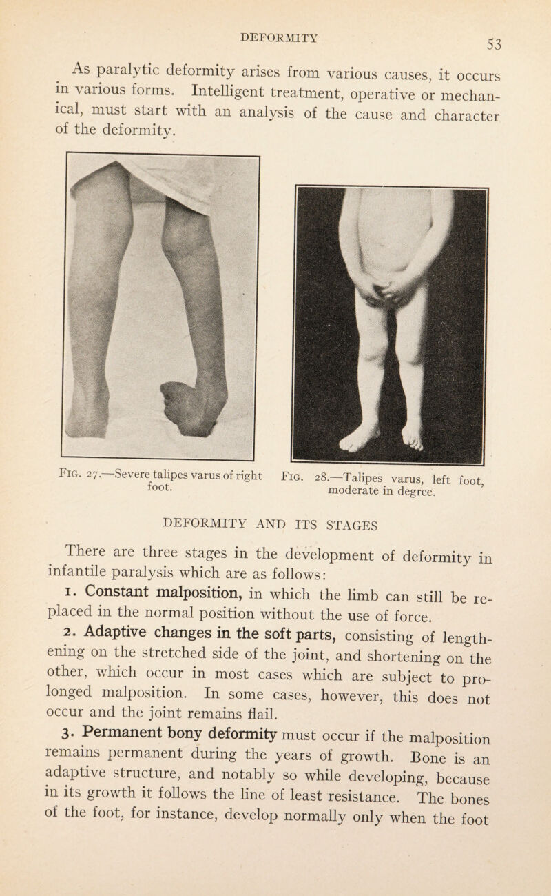 53 As paralytic deformity arises from various causes, it occurs in \arious forms. Intelligent treatment, operative or mechan¬ ical, must start with an analysis of the cause and character of the deformity. Fig. 27.—Severe talipes varus of right foot. Fig. 28.—Talipes varus, left foot, moderate in degree. DEFORMITY AND ITS STAGES There are three stages in the development of deformity in infantile paralysis which are as follows : 1. Constant malposition, in which the limb can still be re¬ placed in the normal position without the use of force. 2. Adaptive changes in the soft parts, consisting of length¬ ening on the stretched side of the joint, and shortening on the other, which occur in most cases which are subject to pro¬ longed malposition. In some cases, however, this does not occur and the joint remains flail. 3* Permanent bony deformity must occur if the malposition remains permanent during the years of growth. Tone is an adaptive structure, and notably so while developing, because m its growth it follows the line of least resistance. The bones of the foot, for instance, develop normally only when the foot