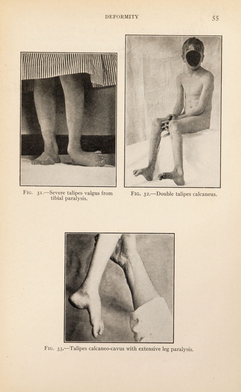 Fig. 31.—Severe talipes valgus from tibial paralysis. Fig. 32.—Double talipes calcaneus. Fig. 33.—Talipes calcaneo-cavus with extensive leg paralysis.