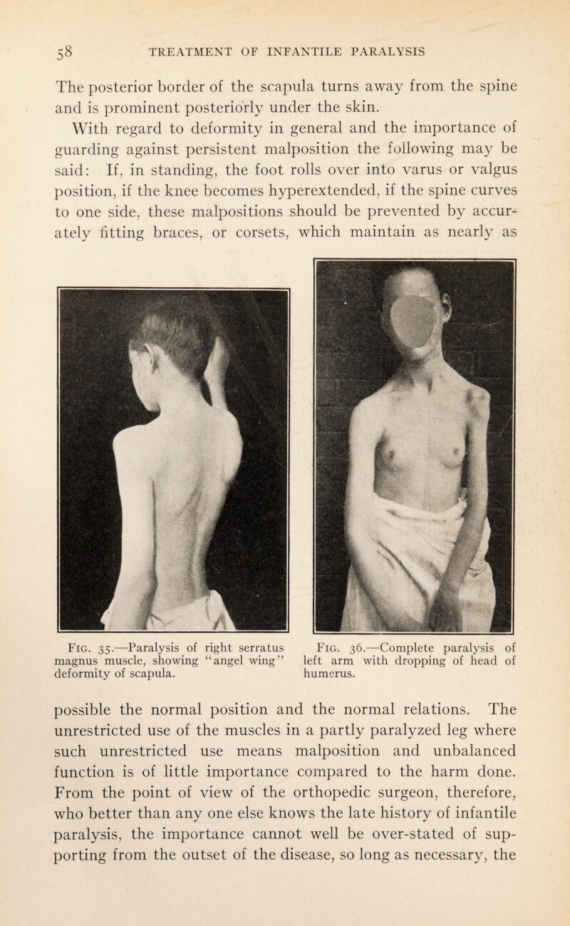 The posterior border of the scapula turns away from the spine and is prominent posteriorly under the skin. With regard to deformity in general and the importance of guarding against persistent malposition the following may be said: If, in standing, the foot rolls over into varus or valgus position, if the knee becomes hyperextended, if the spine curves to one side, these malpositions should be prevented by accur¬ ately fitting braces, or corsets, which maintain as nearly as Fig. 35.—Paralysis of right serratus Fig. 36.—Complete paralysis of magnus muscle, showing “angel wing” left arm with dropping of head of deformity of scapula. humerus. possible the normal position and the normal relations. The unrestricted use of the muscles in a partly paralyzed leg where such unrestricted use means malposition and unbalanced function is of little importance compared to the harm done. From the point of view of the orthopedic surgeon, therefore, who better than any one else knows the late history of infantile paralysis, the importance cannot well be over-stated of sup¬ porting from the outset of the disease, so long as necessary, the