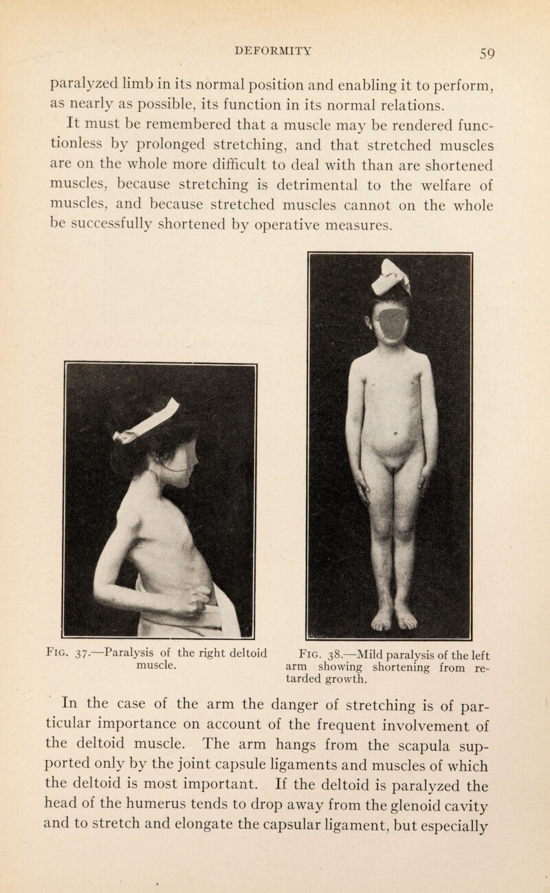 paralyzed limb in its normal position and enabling it to perform, as nearly as possible, its function in its normal relations. It must be remembered that a muscle may be rendered func¬ tionless by prolonged stretching, and that stretched muscles are on the whole more difficult to deal with than are shortened muscles, because stretching is detrimental to the welfare of muscles, and because stretched muscles cannot on the whole be successfully shortened by operative measures. Fig. 37.—Paralysis of the right deltoid muscle. Fig. 38.—Mild paralysis of the left arm showing shortening from re¬ tarded growth. In the case of the arm the danger of stretching is of par¬ ticular importance on account of the frequent involvement of the deltoid muscle. The arm hangs from the scapula sup¬ ported only by the joint capsule ligaments and muscles of which the deltoid is most important. If the deltoid is paralyzed the head of the humerus tends to drop away from the glenoid cavity and to stretch and elongate the capsular ligament, but especially