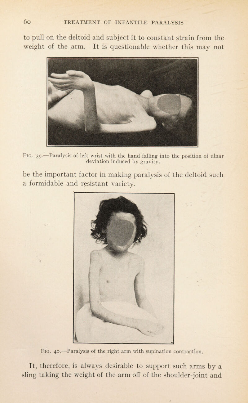 to pull on the deltoid and subject it to constant strain from the weight of the arm. It is questionable whether this may not Fig. 39.—Paralysis of left wrist with the hand falling into the position of ulnar deviation induced by gravity. be the important factor in making paralysis of the deltoid such a formidable and resistant variety. Fig. 40.—Paralysis of the right arm with supination contraction. It, therefore, is always desirable to support such arms by a sling taking the weight of the arm off of the shoulder-joint and