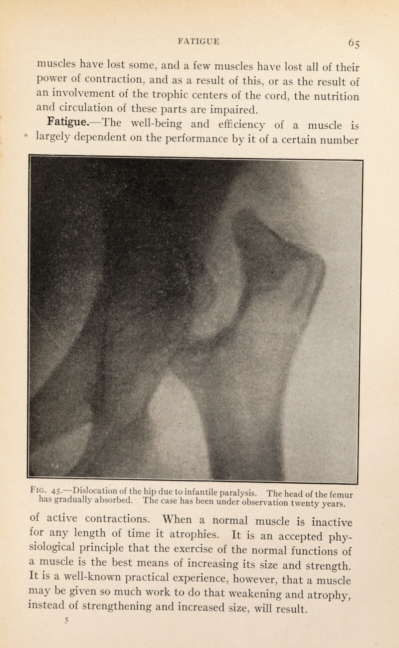 6S muscles have lost some, and a few muscles have lost all of their power of contraction, and as a result of this, or as the result of an involvement of the trophic centers of the cord, the nutrition and circulation of these parts are impaired. Fatigue. The well-being and efficiency of a muscle is largely dependent on the performance by it of a certain number of active contractions. When a normal muscle is inactive for any length of time it atrophies. It is an accepted phy¬ siological principle that the exercise of the normal functions of a muscle is the best means of increasing its size and strength. It is a well-known practical experience, however, that a muscle may be given so much work to do that weakening and atrophy, instead of strengthening and increased size, will result. 5