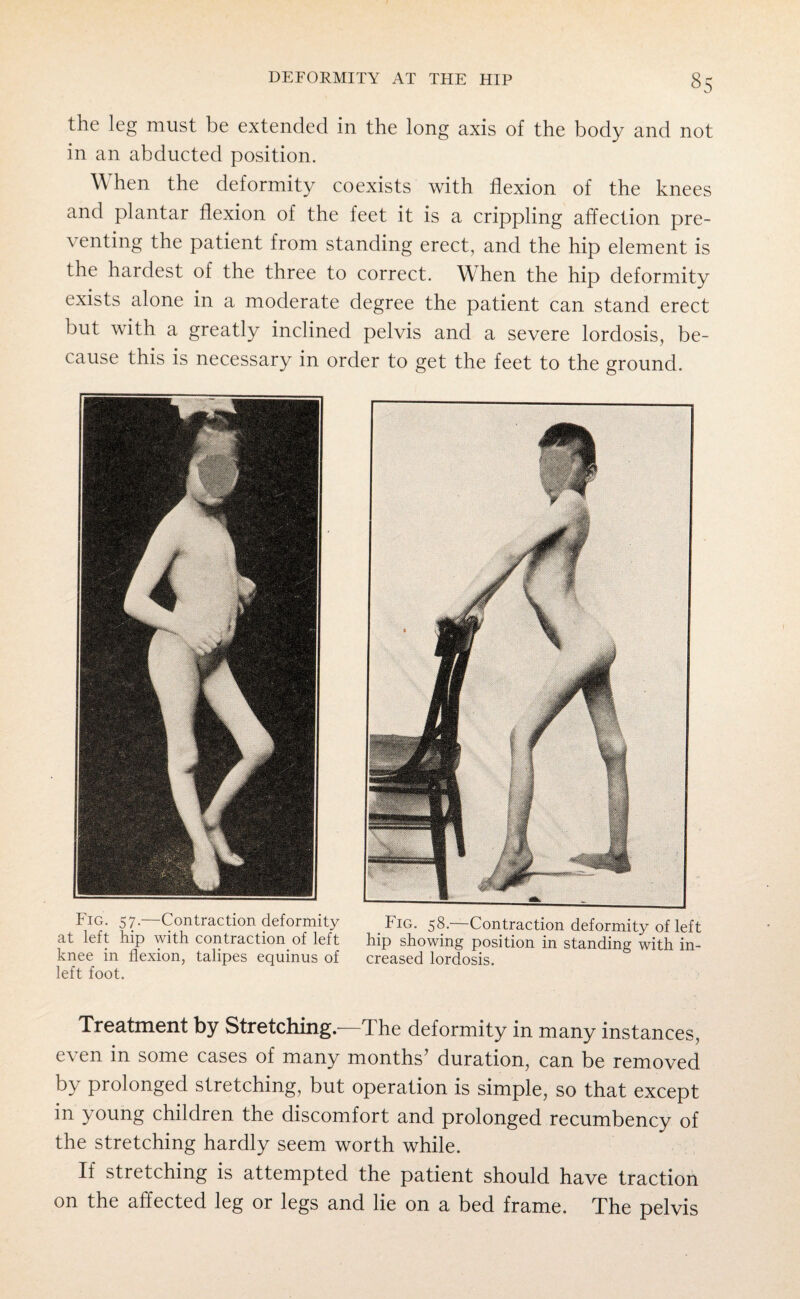 Fig. 57—Contraction deformity Fig. 58—Contraction deformity of left at left hip with contraction of left hip showing position in standing with in¬ knee in flexion, talipes equinus of creased lordosis, left foot. Treatment by Stretching.—The deformity in many instances, even in some cases of many months' duration, can be removed by prolonged stretching, but operation is simple, so that except in young children the discomfort and prolonged recumbency of the stretching hardly seem worth while. If stretching is attempted the patient should have traction on the affected leg or legs and lie on a bed frame. The pelvis the leg must be extended in the long axis of the body and not in an abducted position. When the deformity coexists with flexion of the knees and plantar flexion of the feet it is a crippling affection pre¬ venting the patient from standing erect, and the hip element is the hardest of the three to correct. When the hip deformity exists alone in a moderate degree the patient can stand erect but with a greatly inclined pelvis and a severe lordosis, be¬ cause this is necessary in order to get the feet to the ground.