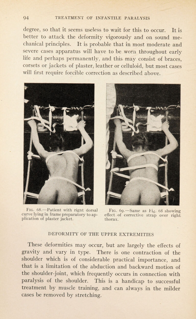 degree, so that it seems useless to wait for this to occur. It is better to attack the deformity vigorously and on sound me¬ chanical principles. It is probable that in most moderate and severe cases apparatus will have to be worn throughout early life and perhaps permanently, and this may consist of braces, corsets or jackets of plaster, leather or celluloid, but most cases will first require forcible correction as described above. DEFORMITY OF THE UPPER EXTREMITIES These deformities may occur, but are largely the effects of gravity and vary in type. There is one contraction of the shoulder which is of considerable practical importance, and that is a limitation of the abduction and backward motion of the shoulder-joint, which frequently occurs in connection with paralysis of the shoulder. This is a handicap to successful treatment by muscle training, and can always in the milder cases be removed by stretching. Fig. 68.—Patient with rignt dorsal curve lying in frame preparatory to ap¬ plication of plaster jacket. Fig. 69.—Same as tig. 68 showing effect of corrective strap over right thorax.