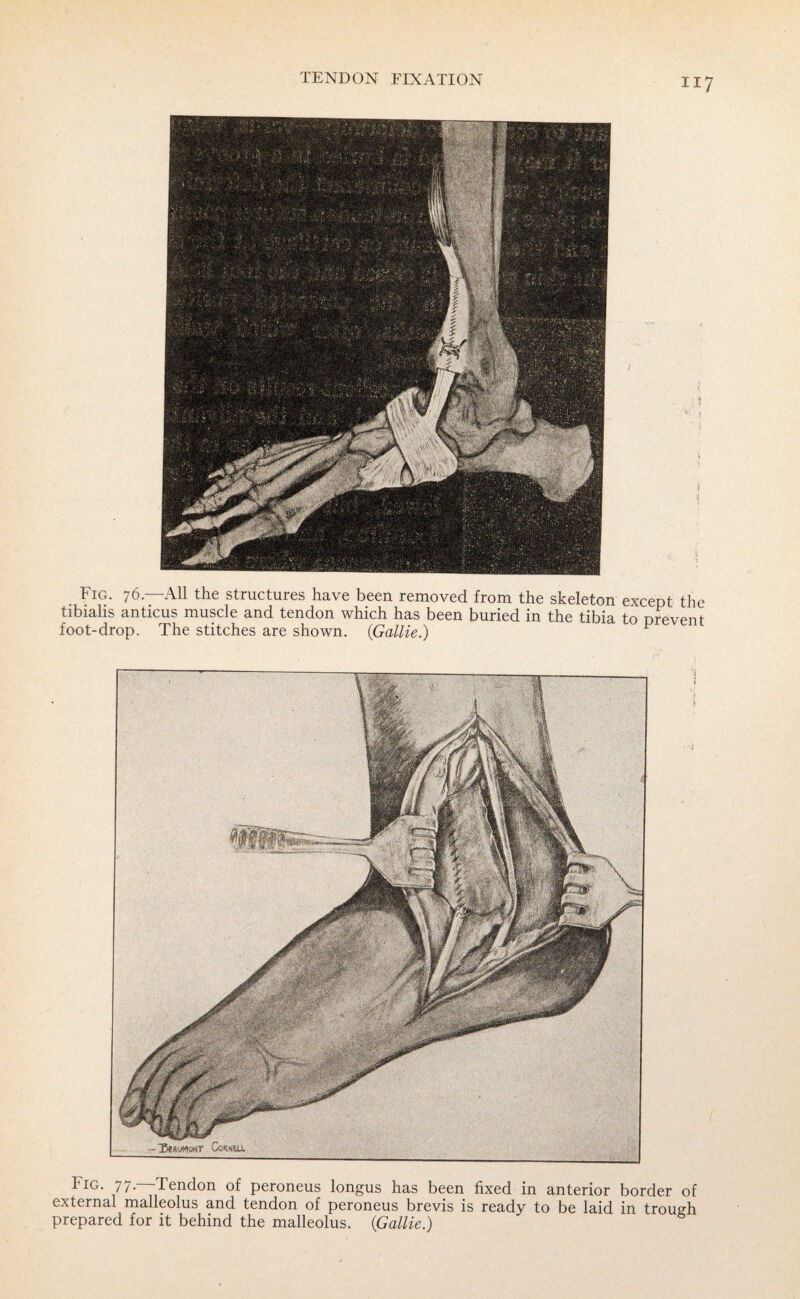 fIG- 77-~Iendon of peroneus longus has been fixed in anterior border of external malleolus and tendon of peroneus brevis is ready to be laid in trough prepared for it behind the malleolus. (<Gallie.) TENDON FIXATION Fig. 76.—All the structures have been removed from the skeleton except the tibialis anticus muscle and tendon which has been buried in the tibia to prevent foot-drop. The stitches are shown. {Gallie.) 1 CoKNOi.