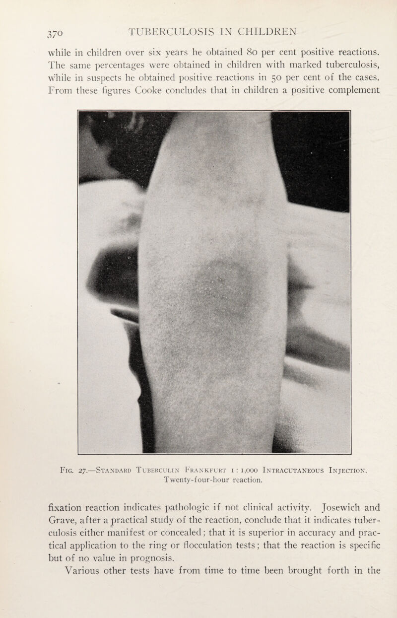 3/0 while in children over six years he obtained 80 per cent positive reactions. The same percentages were obtained in children with marked tuberculosis, while in suspects he obtained positive reactions in 50 per cent of the cases. Lrom these figures Cooke concludes that in children a positive complement Fig. 27.—Standard Tuberculin Frankfurt 1:1,000 Intracutaneous Injection. Twenty-four-hour reaction. fixation reaction indicates pathologic if not clinical activity. Josewich and Grave, after a practical study of the reaction, conclude that it indicates tuber¬ culosis either manifest or concealed; that it is superior in accuracy and prac¬ tical application to the ring or flocculation tests; that the reaction is specific but of no value in prognosis. Various other tests have from time to time been brought forth in the