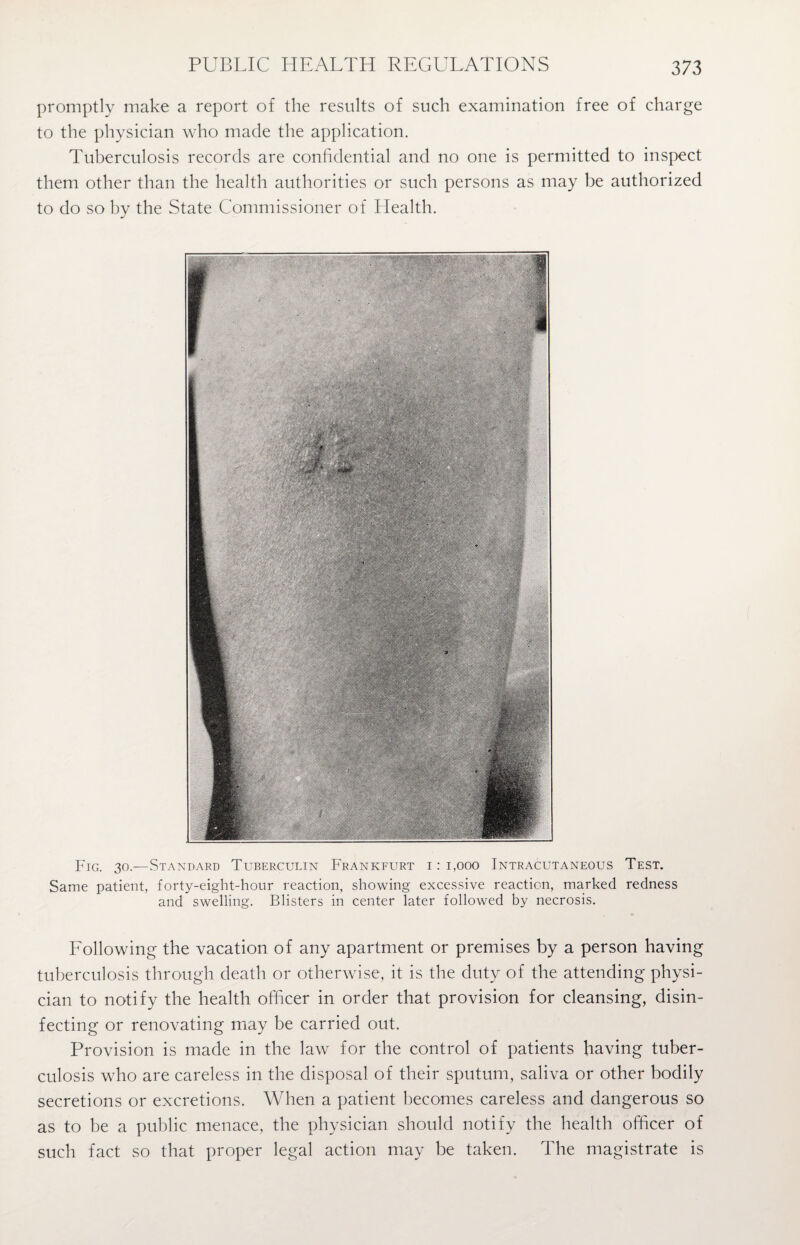 promptly make a report of the results of such examination free of charge to the physician who made the application. Tuberculosis records are confidential and no one is permitted to inspect them other than the health authorities or such persons as may be authorized to do so by the State Commissioner of Health. Fig. 30.—Standard Tuberculin Frankfurt i : 1,000 Intracutaneous Test. Same patient, forty-eight-hour reaction, showing excessive reaction, marked redness and swelling. Blisters in center later followed by necrosis. Following the vacation of any apartment or premises by a person having tuberculosis through death or otherwise, it is the duty of the attending physi¬ cian to notify the health officer in order that provision for cleansing, disin¬ fecting or renovating may be carried out. Provision is made in the law for the control of patients having tuber¬ culosis who are careless in the disposal of their sputum, saliva or other bodily secretions or excretions. When a patient becomes careless and dangerous so as to be a public menace, the physician should notify the health officer of such fact so that proper legal action may be taken. The magistrate is