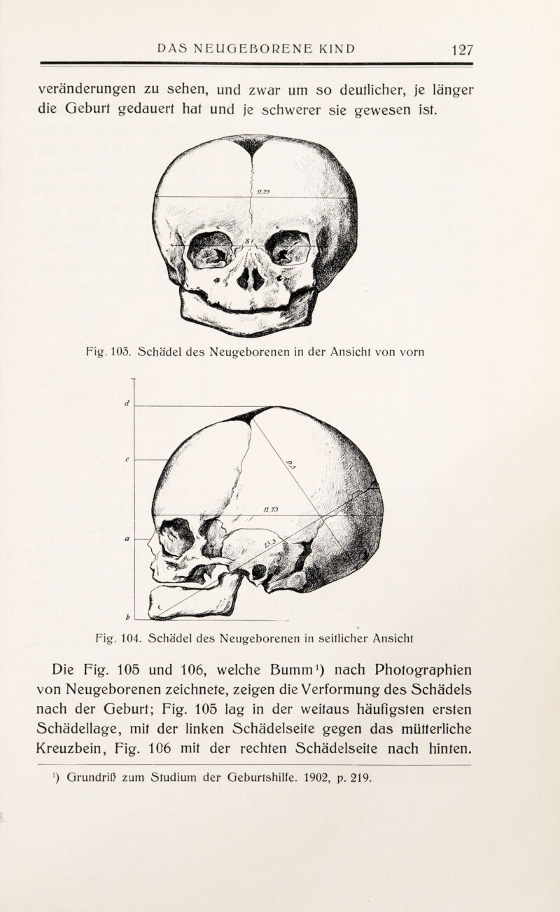 Veränderungen zu sehen, und zwar um so deutlicher, je länger die Geburt gedauert hat und je schwerer sie gewesen ist. Fig. 105. Schädel des Neugeborenen in der Ansicht von vorn Fig. 104. Schädel des Neugeborenen in seitlicher Ansicht Die Fig. 105 und 106, welche 13 um in') nach Photographien von Neugeborenen zeichnete, zeigen die Verformung des Schädels nach der Geburt; Fig. 105 lag in der weitaus häufigsten ersten Schädellage, mit der linken Schädelseite gegen das mütterliche Kreuzbein, Fig. 106 mit der rechten Schädelseile nach hinten. 0 Grundriß zum Studium der Geburtshilfe. 1902, p. 219.