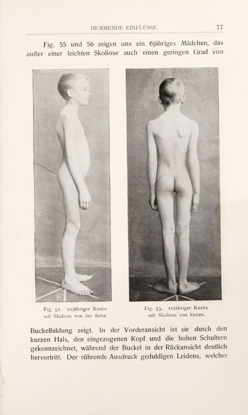 Fig. 55 und 56 zeigen uns ein 6jähriges Mädchen, das außer einer leichten Skoliose auch einen geringen Grad von Fig. 52. iojähriger Knabe Fig. 53. iojähriger Knabe mit Skoliose von der Seite. mit Skoliose von hinten. Buckelbildung zeigt. In der Vorderansicht ist sie durch den kurzen Hals, den eingezogenen Kopf und die hohen Schultern gekennzeichnet, während der Buckel in der Rückansicht deutlich hervortritt. Der rührende Ausdruck geduldigen Leidens, welcher