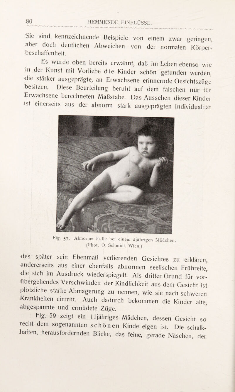 Sie sind kennzeichnende Beispiele von einem zwar geringen. aber docli deutlichen Abweichen von der normalen Körper- Beschaffenheit. Es wurde oben bereits erwähnt, daß im Leben ebenso wie m der Kunst mit Vorliebe die Kinder schön gefunden werden, die stärker ausgeprägte, an Erwachsene erinnernde Gesichtszüge besitzen. Diese Beurteilung beruht auf dem falschen nur für Erwachsene berechneten Maßstabe. Das Aussehen dieser Kinder idt einerseits aus der abnorm stark ausgeprägten Individualität Ftg. 57. Abnorme Fülle bei einem 2jährigen Mädchen. (Phot. O. Schmidt, Wien.) des später sein Ebenmaß verlierenden Gesichtes zu erklären, andererseits aus einer ebenfalls abnormen seelischen Frühreife, die sich im Ausdruck wiederspiegelt. Als dritter Grund für vor¬ übergehendes Verschwinden der Kindlichkeit aus dem Gesicht ist plötzliche starke Abmagerung zu nennen, wie sie nach schweren Krankheiten eintritt. Auch dadurch bekommen die Kinder alte, abgespannte und ermüdete Züge. Fig. 59 zeigt ein 11 jähriges Mädchen, dessen Gesicht so recht dem sogenannten schönen Kinde eigen ist. Die schalk¬ haften, herausfordernden Blicke, das feine, gerade Näschen. der