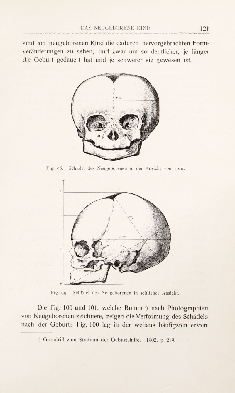 sind am neugeborenen Kind die dadurch hervorgebrachten Form¬ veränderungen zu sehen, und zwar um so deutlicher, je länger die Geburt gedauert hat und je schwerer sie gewesen ist. Fig. 99. Schädel des Neugeborenen in seitlicher Ansicht. Die Fig. 100 und 101, welche Bumm ]) nach Photographien von Neugeborenen zeichnete, zeigen die Verformung des Schädels nach der Geburt; Fig. 100 lag in der weitaus häufigsten ersten 0 Grundriß zum Studium der Geburtshilfe. 1902, p. 219.