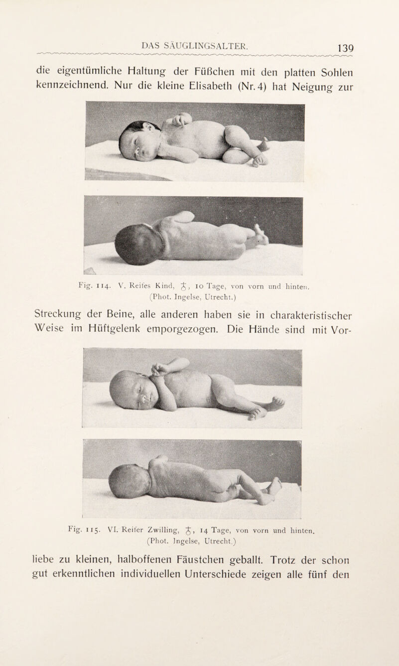 die eigentümliche Haltung der Füßchen mit den platten Sohlen kennzeichnend. Nur die kleine Elisabeth (Nr. 4) hat Neigung zur Fig. 114. V. Reites Kind, 10 Tage, von vorn und hinten. (Phot. Ingelse, Utrecht.) Streckung der Beine, alle anderen haben sie in charakteristischer Weise im Hüftgelenk emporgezogen. Die Hände sind mit Vor- Lig. 115. VI. Reiter Zwilling, ^ , 14 Tage, von vorn und hinten. (Phot. Ingelse, Utrecht.) liebe zu kleinen, halboffenen Fäustchen geballt. Trotz der schon gut erkenntlichen individuellen Unterschiede zeigen alle fünf den