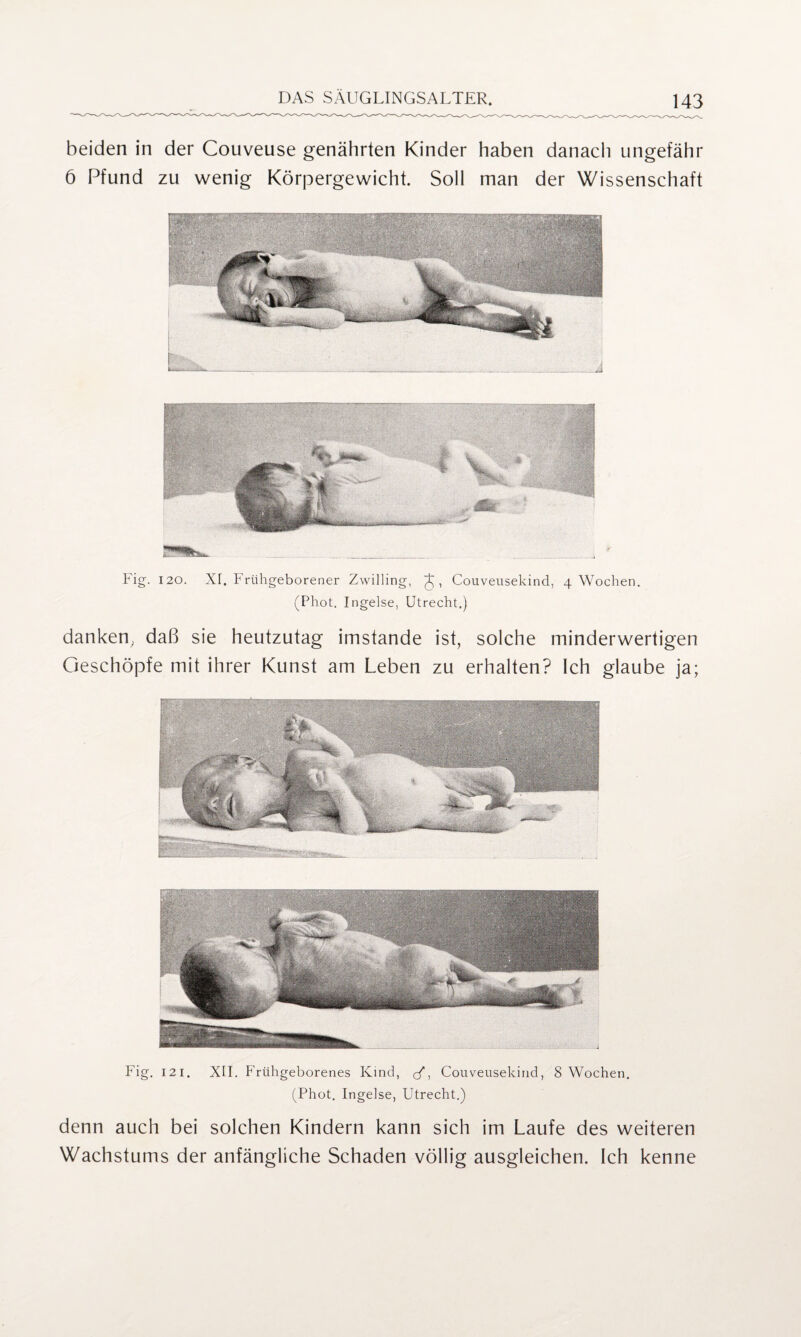 beiden in der Couveuse genährten Kinder haben danach ungefähr 6 Pfund zu wenig Körpergewicht. Soll man der Wissenschaft Fig. 120. xr. Frühgeborener Zwilling, J, Couveusekind, 4 Wochen. (Phot. Ingelse, Utrecht.) danken, daß sie heutzutag imstande ist, solche minderwertigen Geschöpfe mit ihrer Kunst am Leben zu erhalten? Ich glaube ja; Fig. 121. XII. Frühgeborenes Kind, (/, Couveusekind, 8 Wochen. (Phot. Ingelse, Utrecht.) denn auch bei solchen Kindern kann sich im Laufe des weiteren Wachstums der anfängliche Schaden völlig ausgleichen. Ich kenne