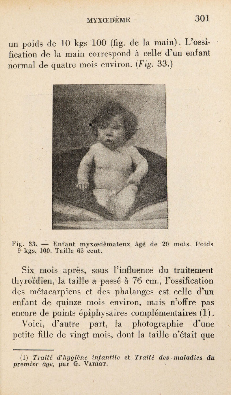 un poids de 10 kgs 100 (fig. de la main). L’ossi¬ fication de la main correspond à celle d’un enfant normal de quatre mois environ. (Fig. 33.) Fig. 33. — Enfant myxœdèmateux âgé de 20 mois. Poids 9 kgs. 100. Taille 65 cent. Six mois après, sous l’influence du traitement thyroïdien, la taille a passé à 76 cm., l’ossification des métacarpiens et des phalanges est celle d’un enfant de quinze mois environ, mais n’offre pas encore de points épiphysaires complémentaires (1). Voici, d’autre part, la. photographie d’une petite fille de vingt mois, dont la taille n’était que (1) Traité d’hygiène infantile et Traité des maladies du premier âge, par G. Variot.