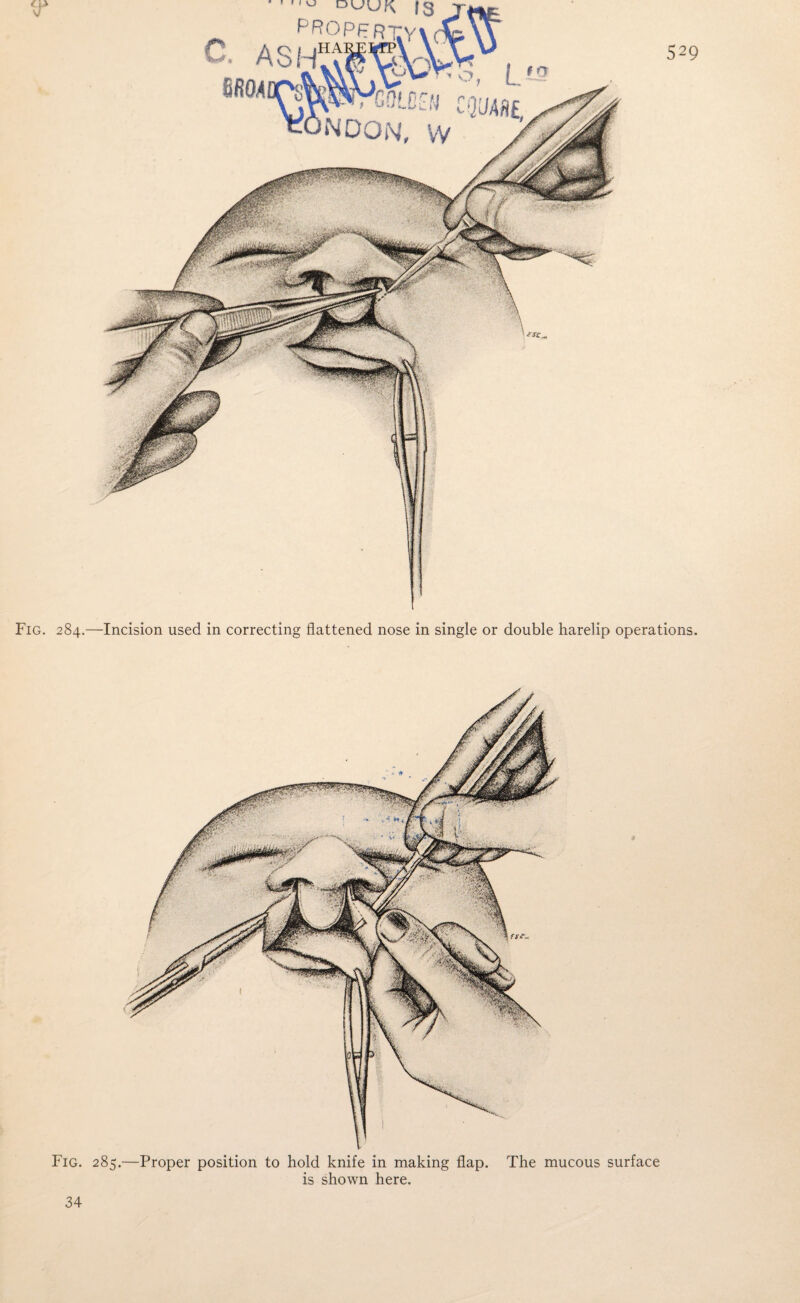 Fig. 284.—Incision used in correcting flattened nose in single or double harelip operations. Fig. 285 9 .—Proper position to hold knife in making flap. The mucous surface is shown here. 34