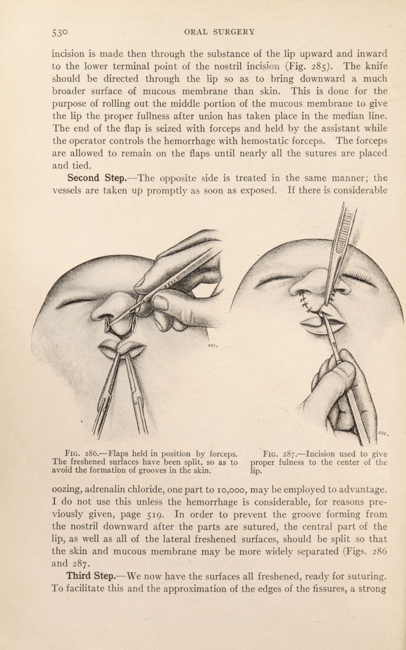 incision is made then through the substance of the ]ip upward and inward to the lower terminal point of the nostril incision (Fig. 285). The knife should be directed through the lip so as to bring downward a much broader surface of mucous membrane than skin. This is done for the purpose of rolling out the middle portion of the mucous membrane to give the lip the proper fullness after union has taken place in the median line. The end of the flap is seized with forceps and held by the assistant while the operator controls the hemorrhage with hemostatic forceps. The forceps are allowed to remain on the flaps until nearly all the sutures are placed and tied. Second Step.—The opposite side is treated in the same manner; the vessels are taken up promptly as soon as exposed. If there is considerable Fig. 286.—Flaps held in position by forceps. Fig. 287.—Incision used to give The freshened surfaces have been split, so as to proper fulness to the center of the avoid the formation of grooves in the skin. lip. oozing, adrenalin chloride, one part to 10,000, may be employed to advantage. I do not use this unless the hemorrhage is considerable, for reasons pre¬ viously given, page 519. In order to prevent the groove forming from the nostril downward after the parts are sutured, the central part of the lip, as well as all of the lateral freshened surfaces, should be split so that the skin and mucous membrane may be more widely separated (Figs. 286 and 287. Third Step .—We now have the surfaces all freshened, ready for suturing. To facilitate this and the approximation of the edges of the fissures, a strong