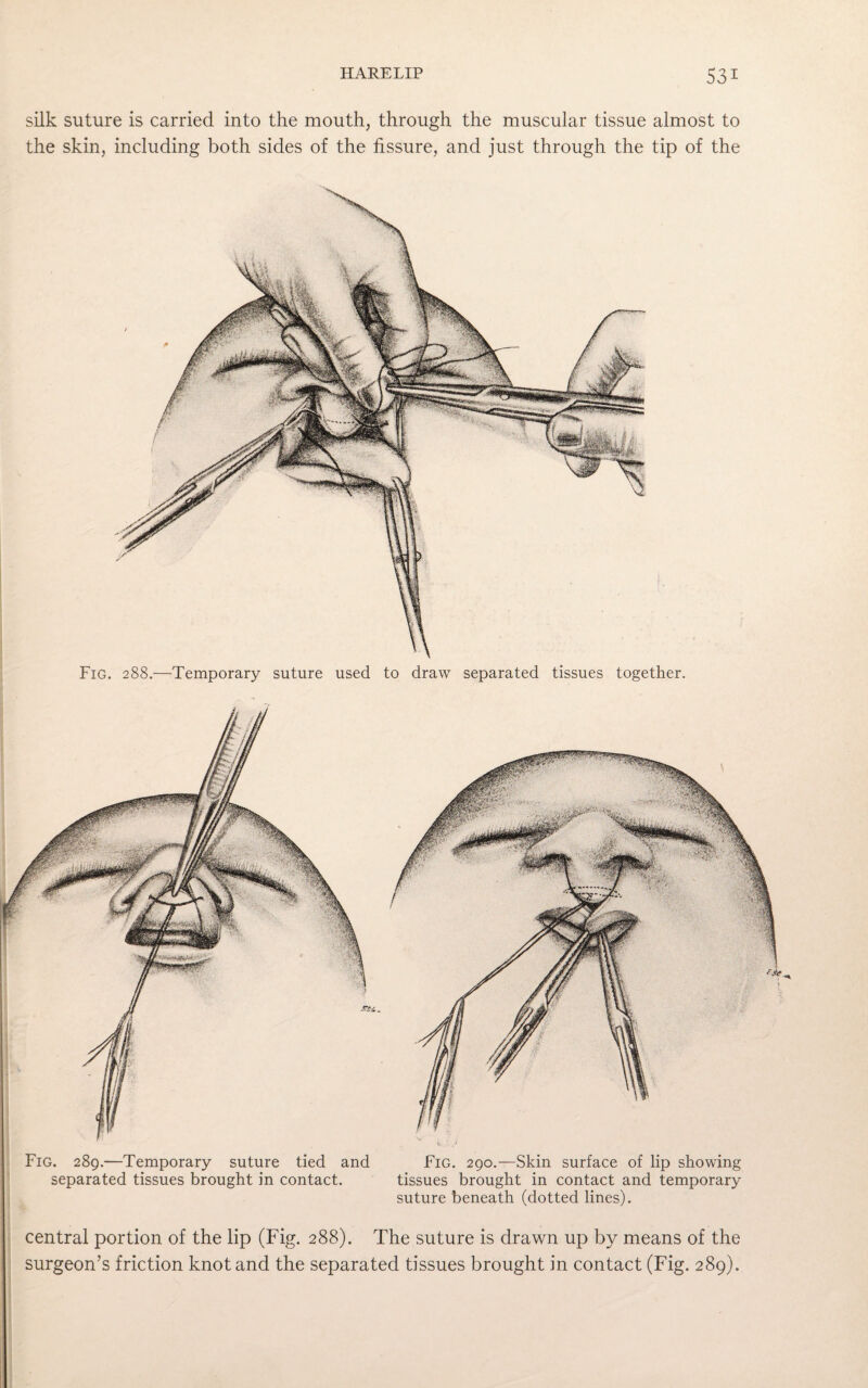 silk suture is carried into the mouth, through the muscular tissue almost to the skin, including both sides of the fissure, and just through the tip of the Fig. 288.—Temporary suture used to draw separated tissues together. Fig. 289.—Temporary suture tied and separated tissues brought in contact. Fig. 290.—Skin surface of lip showing tissues brought in contact and temporary suture beneath (dotted lines). central portion of the lip (Fig. 288). The suture is drawn up by means of the surgeon’s friction knot and the separated tissues brought in contact (Fig. 289).