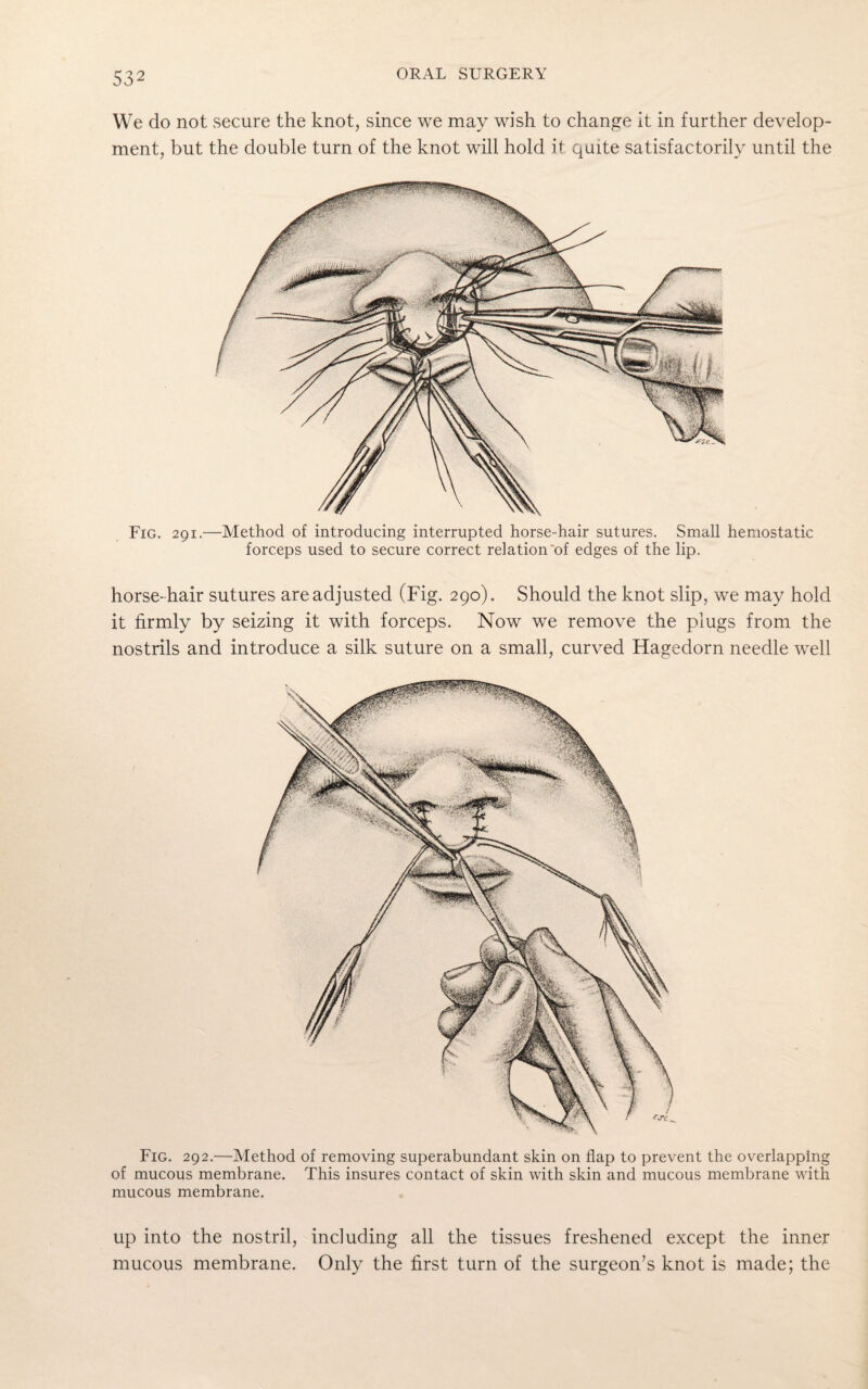 We do not secure the knot, since we may wish to change it in further develop¬ ment, but the double turn of the knot will hold it quite satisfactorily until the Fig. 291.—Method of introducing interrupted horse-hair sutures. Small hemostatic forceps used to secure correct relation'of edges of the lip. horse-hair sutures are adjusted (Fig. 290). Should the knot slip, we may hold it firmly by seizing it with forceps. Now we remove the plugs from the nostrils and introduce a silk suture on a small, curved Hagedorn needle well Fig. 292.—Method of removing superabundant skin on flap to prevent the overlapping of mucous membrane. This insures contact of skin with skin and mucous membrane with mucous membrane. up into the nostril, including all the tissues freshened except the inner mucous membrane. Only the first turn of the surgeon’s knot is made; the