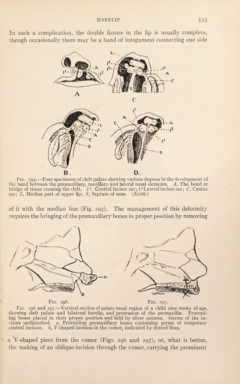 In such a complication, the double fissure in the lip is usually complete, though occasionally there may be a band of integument connecting one side B. D. Fig. 295.—Four specimens of cleft palate showing various degrees in the development of the bond between the premaxillary, maxillary and lateral nasal elements. A, The bond or bridge of tissue crossing the cleft. I h Central incisor sac; l2Lateral incisor sac; C, Canine sac; Z, Median part of upper lip; S, Septum of nose. {Keith.) of it with the median line (Fig. 295). The management of this deformity requires the bringing of the premaxillary bones in proper position by removing Fig. 296 and 297.—Vertical section of palate nasal region of a child nine weeks of age, showing cleft palate and bilateral harelip, and protrusion of the premaxillae. Protrud¬ ing bones placed in their proper position and held by silver sutures. Germs of the in¬ cisors undisturbed, a, Protruding premaxillary bones containing germs of temporary central incisors, h, F-shaped incision in the vomer, indicated by dotted lines. a V-shaped piece from the vomer (Figs. 296 and 297), or, what is better, the making of an oblique incision through the vomer, carrying the prominent