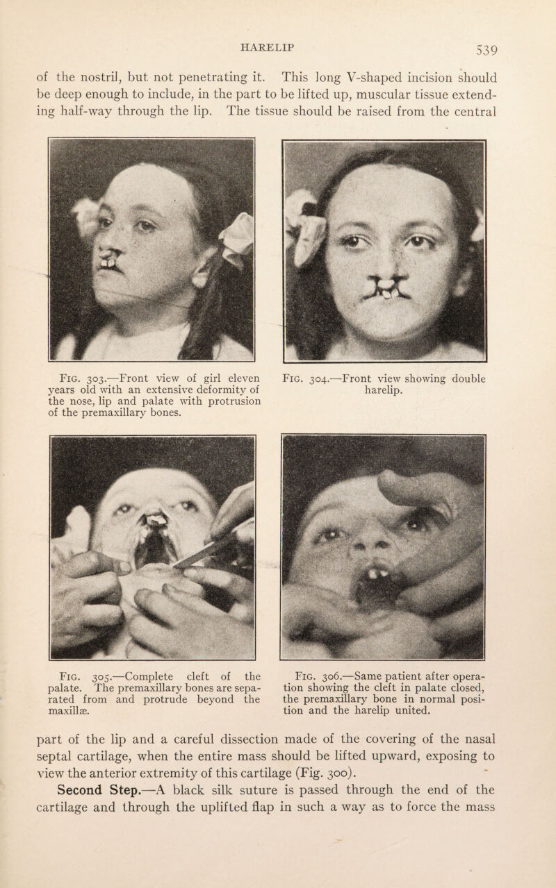 of the nostril, but not penetrating it. This long V-shaped incision should be deep enough to include, in the part to be lifted up, muscular tissue extend¬ ing half-way through the lip. The tissue should be raised from the central Fig. 303.—Front view of girl eleven years old with an extensive deformity of the nose, lip and palate with protrusion of the premaxillary bones. Fig. 305.—Complete cleft of the palate. The premaxillary bones are sepa¬ rated from and protrude beyond the maxillae. Fig. 304.—Front view showing double harelip. Fig. 306.—Same patient after opera¬ tion showing the cleft in palate closed, the premaxillary bone in normal posi¬ tion and the harelip united. part of the lip and a careful dissection made of the covering of the nasal septal cartilage, when the entire mass should be lifted upward, exposing to view the anterior extremity of this cartilage (Fig. 300). Second Step.—A black silk suture is passed through the end of the cartilage and through the uplifted flap in such a way as to force the mass