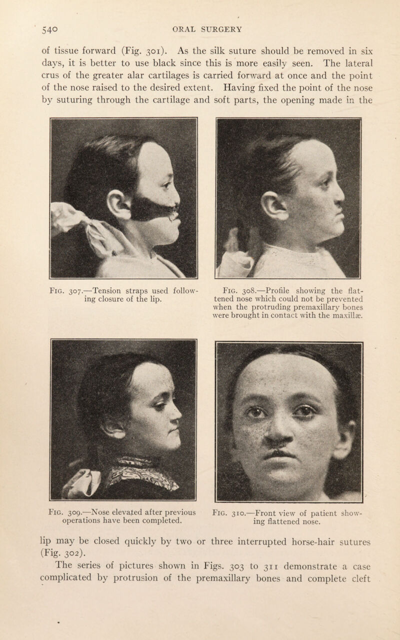 of tissue forward (Fig. 301). As the silk suture should be removed in six days, it is better to use black since this is more easily seen. The lateral crus of the greater alar cartilages is carried forward at once and the point of the nose raised to the desired extent. Having fixed the point of the nose by suturing through the cartilage and soft parts, the opening made in the Fig. 307.—Tension straps used follow¬ ing closure of the lip. Fig. 308.—Profile showing the flat¬ tened nose which could not be prevented when the protruding premaxillary bones were brought in contact with the maxillae. Fig. 309.—Nose elevated after previous Fig. 310.—Front view of patient show- operations have been completed. ing flattened nose. lip may be closed quickly by two or three interrupted horse-hair sutures (Fig. 302). The series of pictures shown in Figs. 303 to 311 demonstrate a case complicated by protrusion of the premaxillary bones and complete cleft