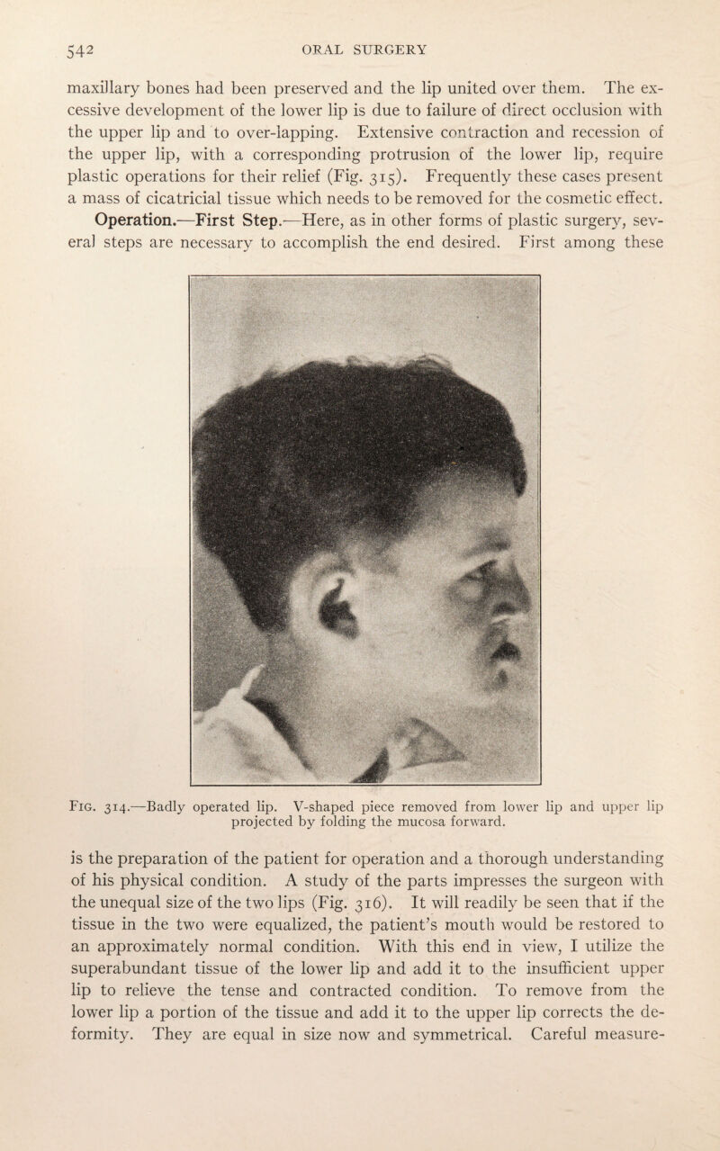 maxillary bones had been preserved and the lip united over them. The ex¬ cessive development of the lower lip is due to failure of direct occlusion with the upper lip and to over-lapping. Extensive contraction and recession of the upper lip, with a corresponding protrusion of the lower lip, require plastic operations for their relief (Fig. 315). Frequently these cases present a mass of cicatricial tissue which needs to be removed for the cosmetic effect. Operation.—First Step.-—Here, as in other forms of plastic surgery, sev¬ eral steps are necessary to accomplish the end desired. First among these Fig. 314.—Badly operated lip. V-shaped piece removed from lower lip and upper lip projected by folding the mucosa forward. is the preparation of the patient for operation and a thorough understanding of his physical condition. A study of the parts impresses the surgeon with the unequal size of the two lips (Fig. 316). It will readily be seen that if the tissue in the two were equalized, the patient’s mouth would be restored to an approximately normal condition. With this end in view, I utilize the superabundant tissue of the lower lip and add it to the insufficient upper lip to relieve the tense and contracted condition. To remove from the lower lip a portion of the tissue and add it to the upper lip corrects the de¬ formity. They are equal in size now and symmetrical. Careful measure-