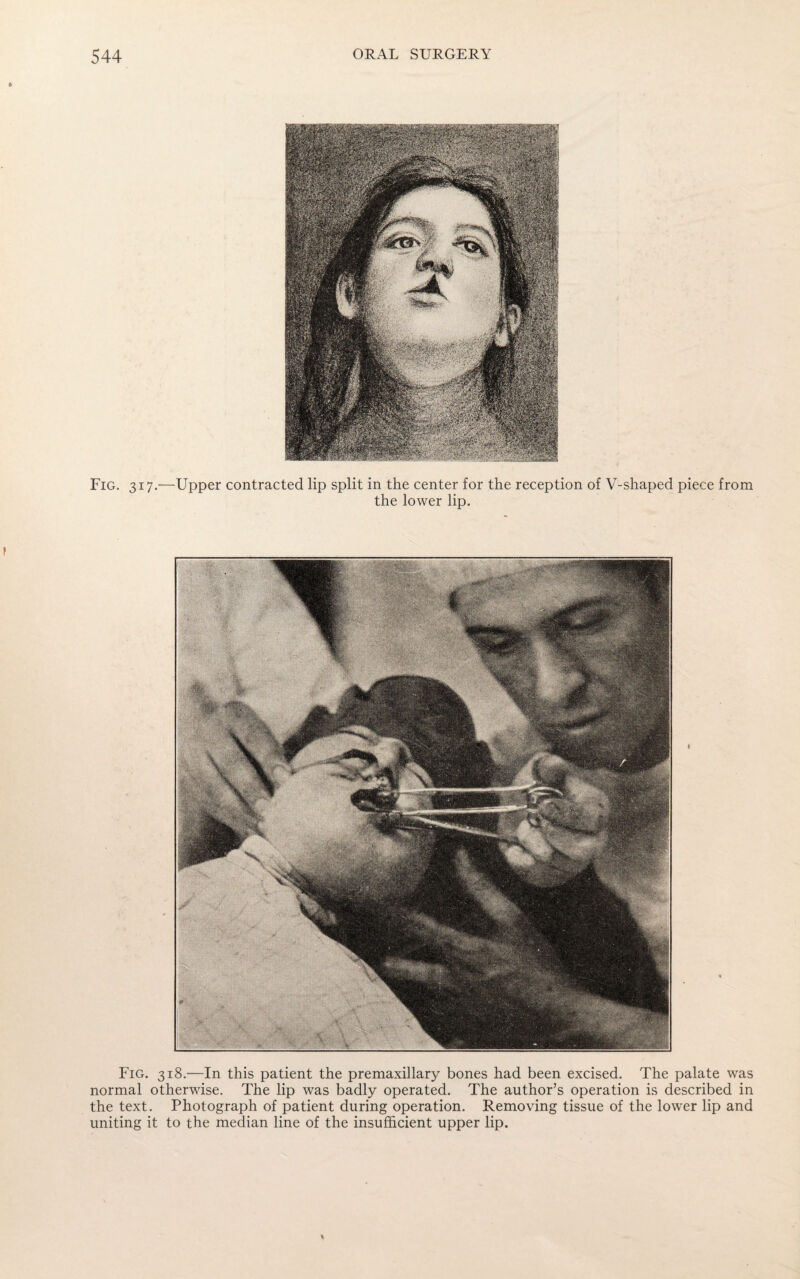 Fig. 317.—Upper contracted lip split in the center for the reception of V-shaped piece from the lower lip. Fig. 318.—In this patient the premaxillary bones had been excised. The palate was normal otherwise. The lip was badly operated. The author’s operation is described in the text. Photograph of patient during operation. Removing tissue of the lower lip and uniting it to the median line of the insufficient upper lip.