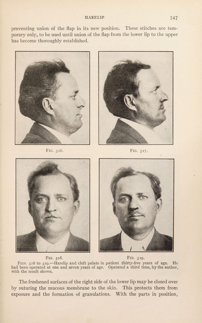 preventing union of the flap in its new position. These stitches are tem¬ porary only, to be used until union of the flap from the lower lip to the upper has become thoroughly established. Fig. 328. Fig. 329. Figs. 326 to 329.—Harelip and cleft palate in patient thirty-five years of age. He had been operated at one and seven years of age. Operated a third time, by the author, with the result shown. The freshened surfaces of the right side of the lower lip may be closed over by suturing the mucous membrane to the skin. This protects them from exposure and the formation of granulations. With the parts in position, Ftg. 326. Fig. 327.