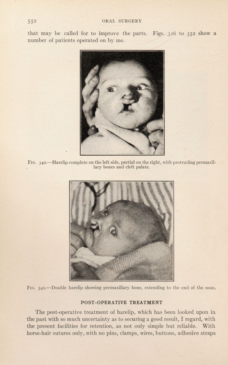 that may be called for to improve the parts. Figs. 326 to 352 show a number of patients operated on by me. Fig. 340.—Harelip complete on the left side, partial on the right, with protruding premaxil¬ lary bones and cleft palate. Fig. 341.—Double harelip showing premaxillary bone, extending to the end of the nose. POST-OPERATIVE TREATMENT The post-operative treatment of harelip, which has been looked upon in the past with so much uncertainty as to securing a good result, I regard, with the present facilities for retention, as not only simple but reliable. With horse-hair sutures only, with no pins, clamps, wires, buttons, adhesive straps