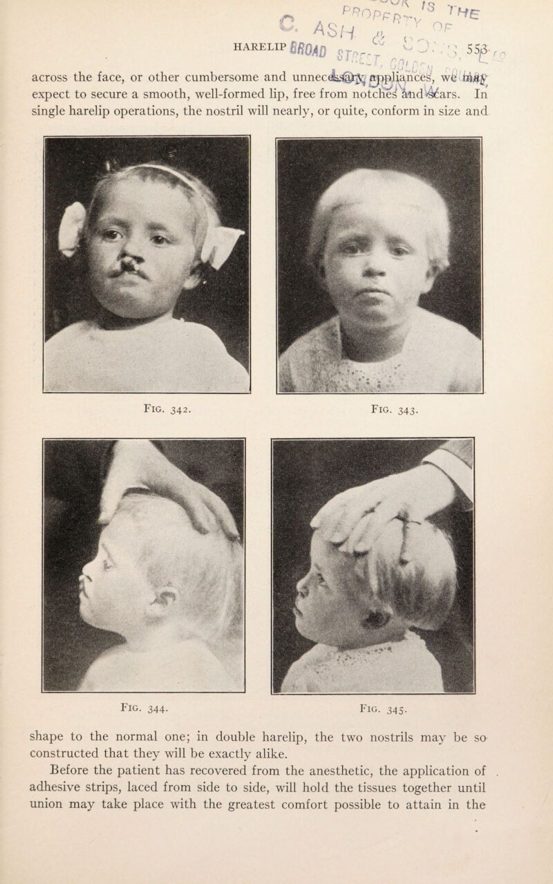 f™ HARELIP D ' I o AS H 1 ^ Ry'v t Q » O Ac & ( < I 55S- L across the face, or other cumbersome and unnec&©$^ appliances, we expect to secure a smooth, well-formed lip, free from notched and46ars. In single harelip operations, the nostril will nearly, or quite, conform in size and Fig. 342. Fig. 343. Fig. 344. Fig. 345. shape to the normal one; in double harelip, the two nostrils may be so constructed that they will be exactly alike. Before the patient has recovered from the anesthetic, the application of adhesive strips, laced from side to side, will hold the tissues together until union may take place with the greatest comfort possible to attain in the