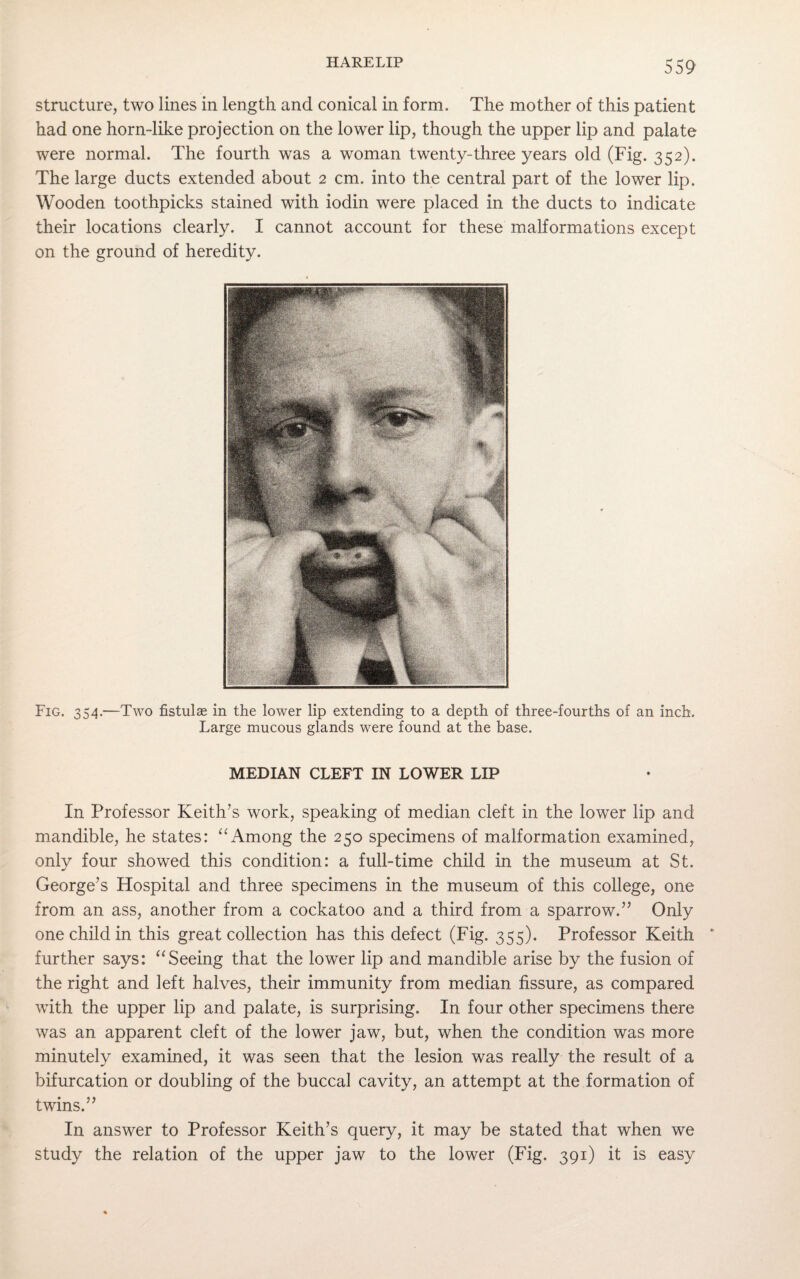 structure, two lines in length and conical in form. The mother of this patient had one horn-like projection on the lower lip, though the upper lip and palate were normal. The fourth was a woman twenty-three years old (Fig. 352). The large ducts extended about 2 cm. into the central part of the lower lip. Wooden toothpicks stained with iodin were placed in the ducts to indicate their locations clearly. I cannot account for these malformations except on the ground of heredity. Fig. 354.—Two fistulae in the lower lip extending to a depth of three-fourths of an inch. Large mucous glands were found at the base. MEDIAN CLEFT IN LOWER LIP In Professor Keith’s work, speaking of median cleft in the lower lip and mandible, he states: “ Among the 250 specimens of malformation examined, only four showed this condition: a full-time child in the museum at St. George’s Hospital and three specimens in the museum of this college, one from an ass, another from a cockatoo and a third from a sparrow.” Only one child in this great collection has this defect (Fig. 355). Professor Keith “ further says: “Seeing that the lower lip and mandible arise by the fusion of the right and left halves, their immunity from median fissure, as compared with the upper lip and palate, is surprising. In four other specimens there was an apparent cleft of the lower jaw, but, when the condition was more minutely examined, it was seen that the lesion was really the result of a bifurcation or doubling of the buccal cavity, an attempt at the formation of twins.” In answer to Professor Keith’s query, it may be stated that when we study the relation of the upper jaw to the lower (Fig. 391) it is easy