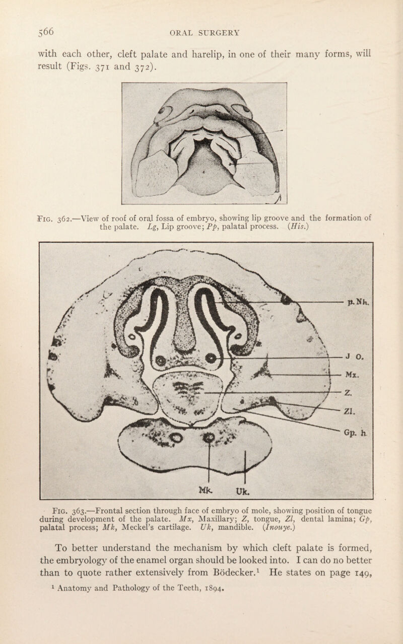 with each other, cleft palate and harelip, in one of their many forms, will result (Figs. 371 and 372). Fig. 362.—View of roof of oral fossa of embryo, showing lip groove and the formation of the palate. Lg, Lip groove; Pp, palatal process. (His.) Fig. 363.—Frontal section through face of embryo of mole, showing position of tongue during development of the palate. Mx, Maxillary; Z, tongue, Zl, dental lamina; Gp, palatal process; Mk, Meckel’s cartilage. Uk, mandible. (Inouye.) To better understand the mechanism by which cleft palate is formed, the embryology of the enamel organ should be looked into. I can do no better than to quote rather extensively from Bbdecker.1 He states on page 149,, 1 Anatomy and Pathology of the Teeth, 1894.