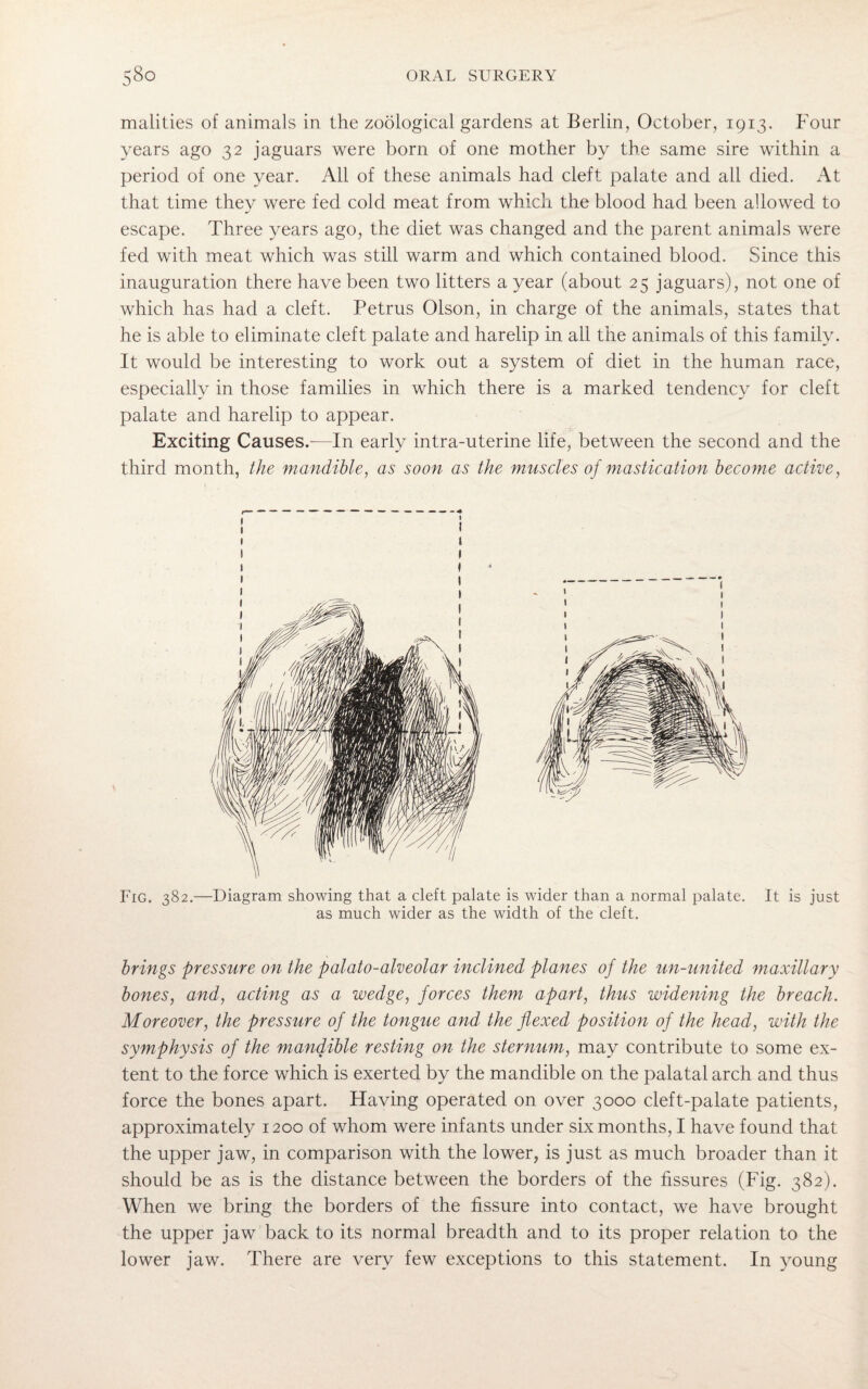 malities of animals in the zoological gardens at Berlin, October, 1913. Four years ago 32 jaguars were born of one mother by the same sire within a period of one year. All of these animals had cleft palate and all died. At that time they were fed cold meat from which the blood had been allowed to escape. Three years ago, the diet was changed and the parent animals were fed with meat which was still warm and which contained blood. Since this inauguration there have been two litters a year (about 25 jaguars), not one of which has had a cleft. Petrus Olson, in charge of the animals, states that he is able to eliminate cleft palate and harelip in all the animals of this family. It would be interesting to work out a system of diet in the human race, especially in those families in which there is a marked tendency for cleft palate and harelip to appear. Exciting Causes.—In early intra-uterine life, between the second and the third month, the mandible, as soon as the muscles of mastication become active, Fig. 382.—Diagram showing that a cleft palate is wider than a normal palate. It is just as much wider as the width of the cleft. brings pressure on the palato-alveolar inclined planes of the un-united maxillary bones, and, acting as a wedge, forces them apart, thus widening the breach. Moreover, the pressure of the tongue and the flexed position of the head, with the symphysis of the mandible resting on the sternum, may contribute to some ex¬ tent to the force which is exerted by the mandible on the palatal arch and thus force the bones apart. Having operated on over 3000 cleft-palate patients, approximately 1200 of whom were infants under six months, I have found that the upper jaw, in comparison with the lower, is just as much broader than it should be as is the distance between the borders of the fissures (Fig. 382). When we bring the borders of the fissure into contact, we have brought the upper jaw back to its normal breadth and to its proper relation to the lower jaw. There are very few exceptions to this statement. In young