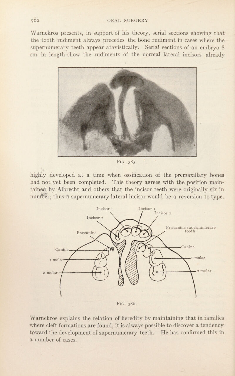 Warnekros presents, in support of his theory, serial sections showing that the tooth rudiment always precedes the bone rudiment in cases where the supernumerary teeth appear atavistically. Serial sections of an embryo 8 cm. in length show the rudiments of the normal lateral incisors already Fig. 385. highly .developed at a time when ossification of the premaxillary bones had not yet been completed. This theory agrees with the position main¬ tained by Albrecht and others that the incisor teeth were originally six in nunfber; thus a supernumerary lateral incisor would be a reversion to type. Incisor i Incisor I Fig. 386. Warnekros explains the relation of heredity by maintaining that in families where cleft formations are found, it is always possible to discover a tendency toward the development of supernumerary teeth. He has confirmed this in a number of cases.