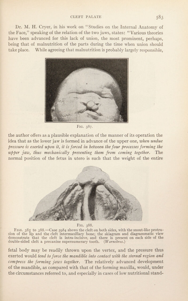 Dr. M. H. Cryer, in his work on “ Studies on the Internal Anatomy of the Face,” speaking of the relation of the two jaws, states: “Various theories have been advanced for this lack of union, the most prominent, perhaps, being that of malnutrition of the parts during the time when union should take place. While agreeing that malnutrition is probably largely responsible, Fig. 387. the author offers as a plausible explanation of the manner of its operation the idea that as the lower jaw is formed in advance of the upper one, when undue pressure is exerted upon it, it is forced in between the four processes forming the upper jaw, thus mechanically preventing them from coming together. The normal position of the fetus in utero is such that the weight of the entire Fig. 388. Figs. 385 to 388.—Case 5984 shows the cleft on both sides, with the snout-like protru¬ sion of the lip and the cleft intermaxillary bone; the skiagram and diagrammatic view demonstrate that the cleft is intra-incisive, and there is present on each side of the double-sided cleft a precanine supernumerary tooth. (Warnekros.) fetal body may be readily thrown upon the vertex, and the pressure thus exerted would tend to force the mandible into contact with the sternal region and compress the forming jaws together. The relatively advanced development of the mandible, as compared with that of the forming maxilla, would, under the circumstances referred to, and especially in cases of low nutritional stand-