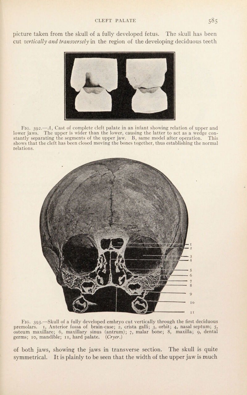 picture taken from the skull of a fully developed fetus. The skull has been cut vertically and transversely in the region of the developing deciduous teeth Fig. 392.—A, Cast of complete cleft palate in an infant showing relation of upper and lower jaws. The upper is wider than the lower, causing the latter to act as a wedge con¬ stantly separating the segments of the upper jaw. B, same model after operation. This shows that the cleft has been closed moving the bones together, thus establishing the normal relations. Fig. 393.—Skull of a fully developed embryo cut vertically through the first deciduous premolars. 1, Anterior fossa of brain-case; 2, crista galli; 3, orbit; 4, nasal septum; 5, osteum maxillare; 6, maxillary sinus (antrum); 7, malar bone; 8, maxilla; 9, dental germs; 10, mandible; 11, hard palate. (Cryer.) of both jaws, showing the jaws in transverse section. The skull is quite symmetrical. It is plainly to be seen that the width of the upper jaw is much