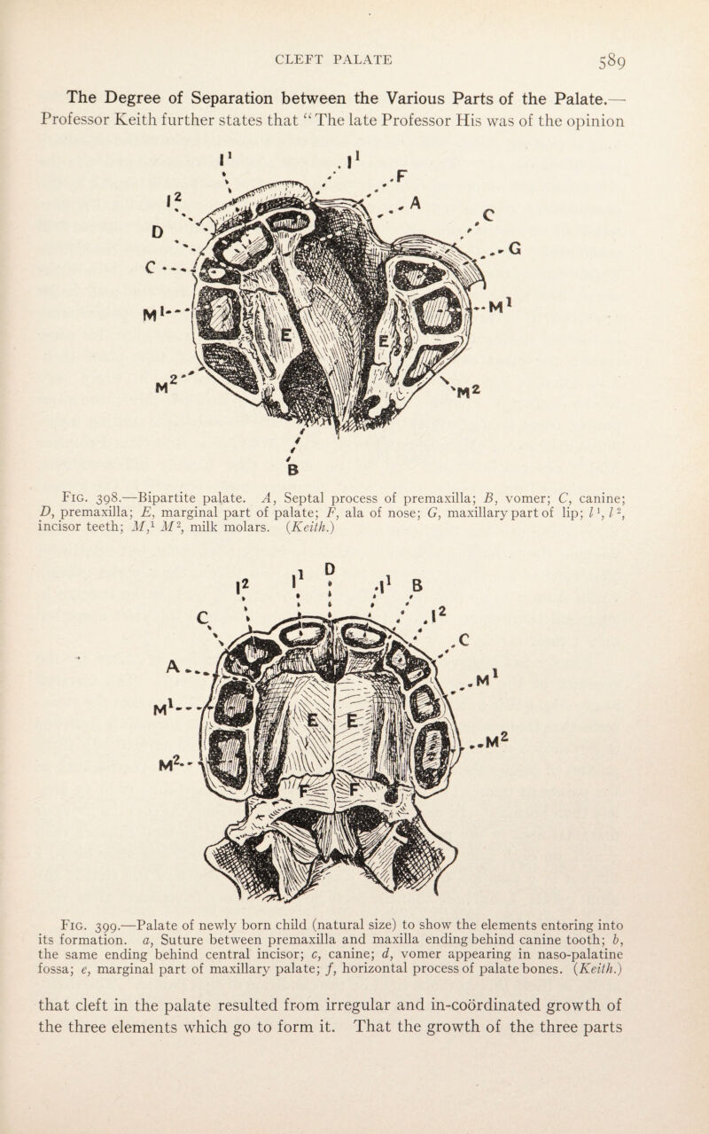 The Degree of Separation between the Various Parts of the Palate.— Professor Keith further states that “The late Professor His was of the opinion B Fig. 398.—Bipartite palate. A, Septal process of premaxilla; B, vomer; C, canine; D, premaxilla; E, marginal part of palate; F, ala of nose; G, maxillary part of lip; l\l2, incisor teeth; M,1 M2, milk molars. {Keith.) Fig. 399.—Palate of newly born child (natural size) to show the elements entering into its formation, a, Suture between premaxilla and maxilla ending behind canine tooth; b, the same ending behind central incisor; c, canine; d, vomer appearing in naso-palatine fossa; e, marginal part of maxillary palate; f, horizontal process of palate bones. {Keith.) that cleft in the palate resulted from irregular and in-coordinated growth of the three elements which go to form it. That the growth of the three parts