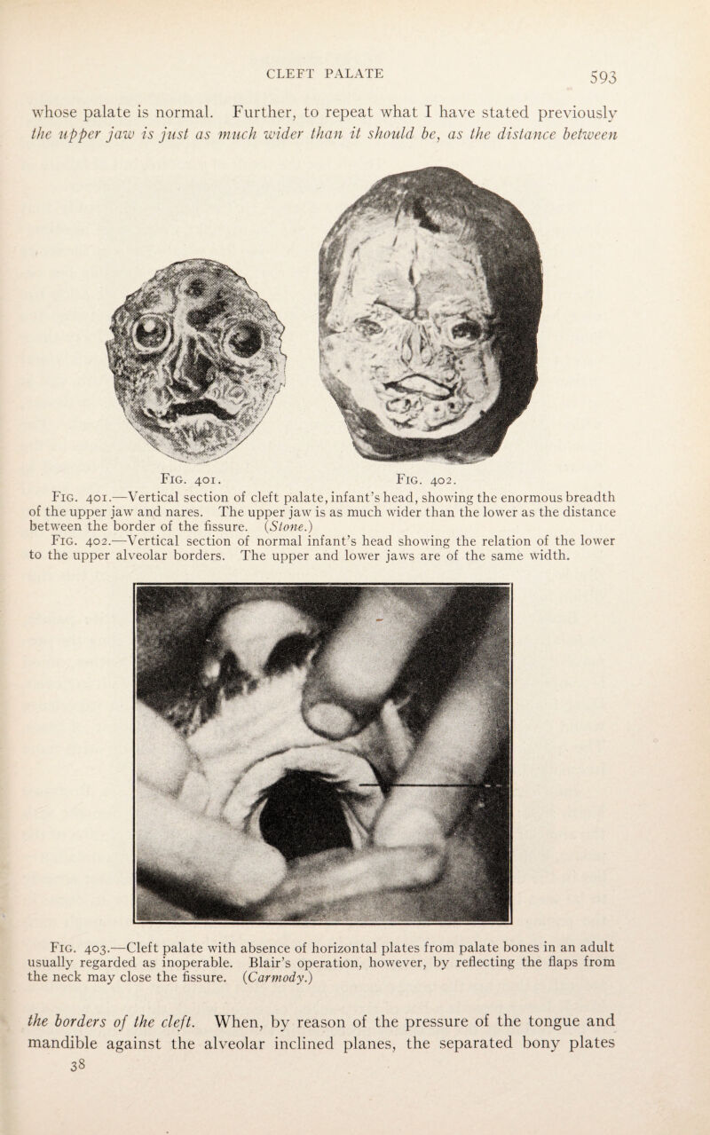 whose palate is normal. Further, to repeat what I have stated previously the upper jaw is just as much wider than it should be, as the distance between Fig. 401. Fig. 402. Fig. 401.—Vertical section of cleft palate, infant’s head, showing the enormous breadth of the upper jaw and nares. The upper jaw is as much wider than the lower as the distance between the border of the fissure. (Stone.) Fig. 402.—Vertical section of normal infant’s head showing the relation of the lower to the upper alveolar borders. The upper and lower jaws are of the same width. Fig. 403.—Cleft palate with absence of horizontal plates from palate bones in an adult usually regarded as inoperable. Blair’s operation, however, by reflecting the flaps from the neck may close the fissure. (Carmody.) the borders of the cleft. When, by reason of the pressure of the tongue and mandible against the alveolar inclined planes, the separated bony plates 38