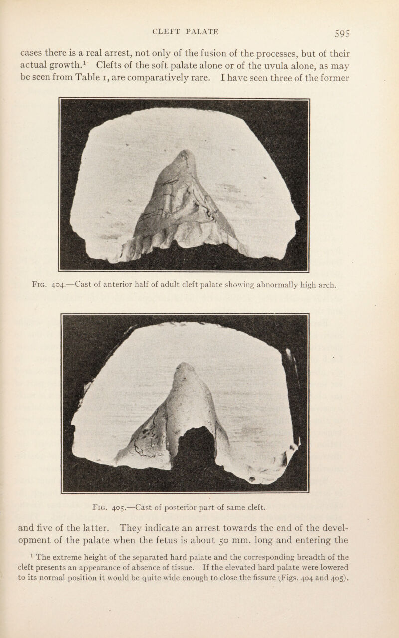 cases there is a real arrest, not only of the fusion of the processes, but of their actual growth.1 Clefts of the soft palate alone or of the uvula alone, as may be seen from Table i, are comparatively rare. I have seen three of the former Fig. 404-—Cast of anterior half of adult cleft palate showing abnormally high arch. Fig. 405.—Cast of posterior part of same cleft. and five of the latter. They indicate an arrest towards the end of the devel¬ opment of the palate when the fetus is about 50 mm. long and entering the 1 The extreme height of the separated hard palate and the corresponding breadth of the cleft presents an appearance of absence of tissue. If the elevated hard palate were lowered to its normal position it would be quite wide enough to close the fissure (.Figs. 404 and 405).