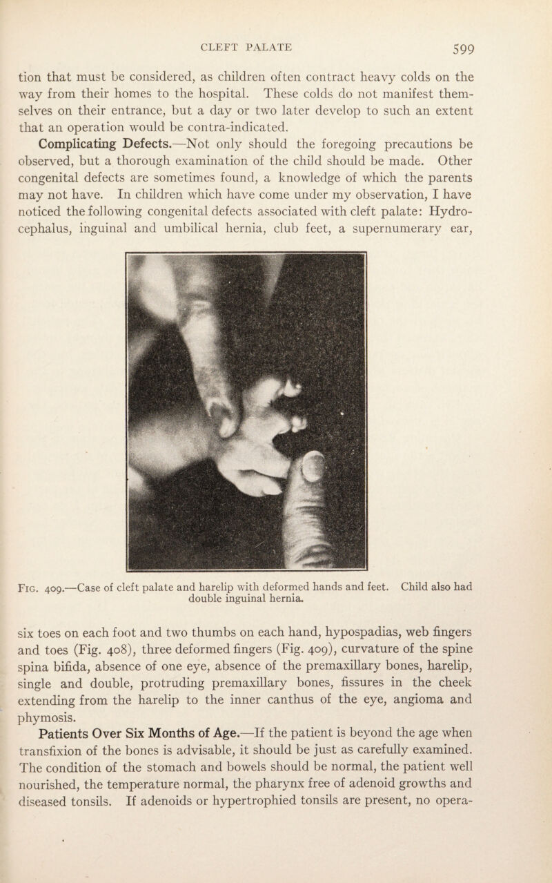 tion that must be considered, as children often contract heavy colds on the way from their homes to the hospital. These colds do not manifest them¬ selves on their entrance, but a day or two later develop to such an extent that an operation would be contra-indicated. Complicating Defects.—Not only should the foregoing precautions be observed, but a thorough examination of the child should be made. Other congenital defects are sometimes found, a knowledge of which the parents may not have. In children which have come under my observation, I have noticed the following congenital defects associated with cleft palate: Hydro¬ cephalus, inguinal and umbilical hernia, club feet, a supernumerary ear, Fig. 409.—Case of cleft palate and harelip with deformed hands and feet. Child also had double inguinal hernia. six toes on each foot and two thumbs on each hand, hypospadias, web fingers and toes (Fig. 408), three deformed fingers (Fig. 409), curvature of the spine spina bifida, absence of one eye, absence of the premaxillary bones, harelip, single and double, protruding premaxillary bones, fissures in the cheek extending from the harelip to the inner canthus of the eye, angioma and * phymosis. Patients Over Six Months of Age.—If the patient is beyond the age when transfixion of the bones is advisable, it should be just as carefully examined. The condition of the stomach and bowels should be normal, the patient well nourished, the temperature normal, the pharynx free of adenoid growths and diseased tonsils. If adenoids or hypertrophied tonsils are present, no opera-